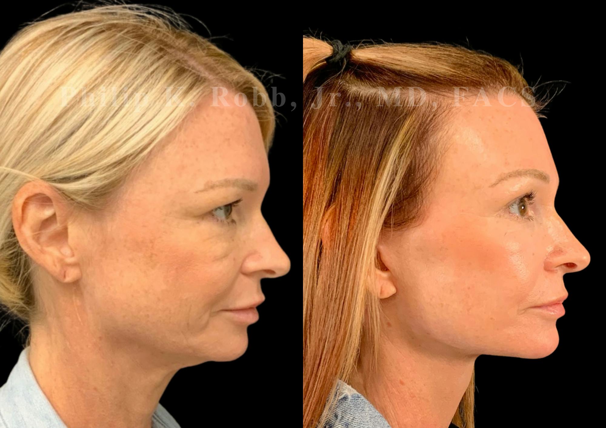 Laser Skin Resurfacing Before & After Gallery - Patient 404737 - Image 6