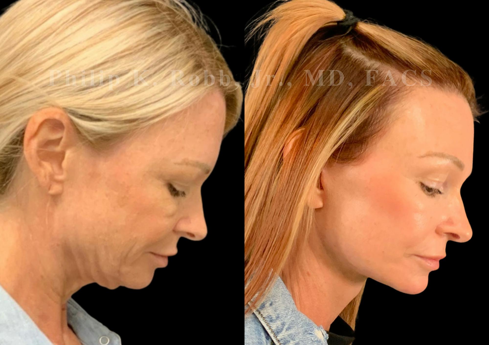 Laser Skin Resurfacing Before & After Gallery - Patient 404737 - Image 7