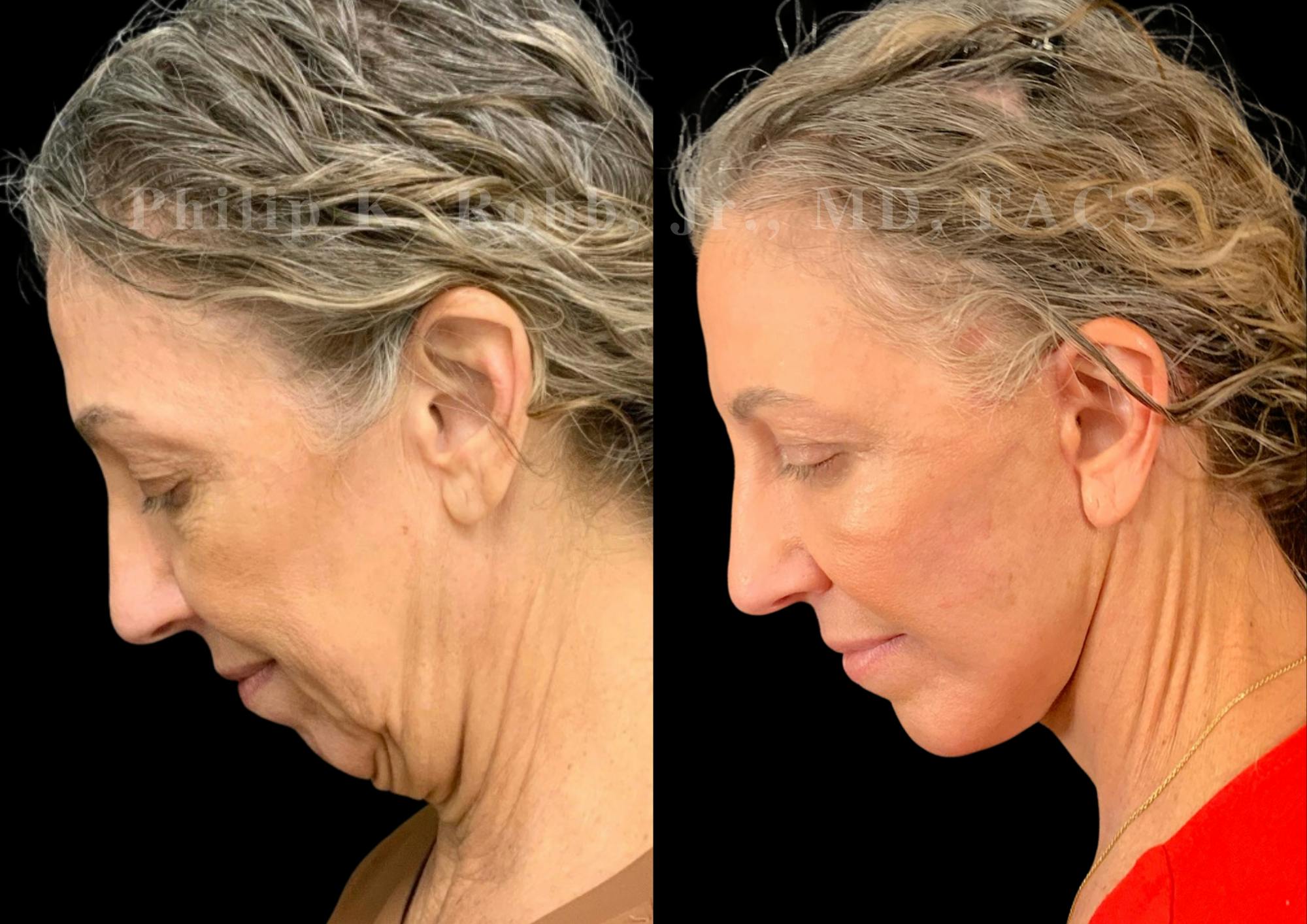 Neck Lift Before & After Gallery - Patient 397586 - Image 2