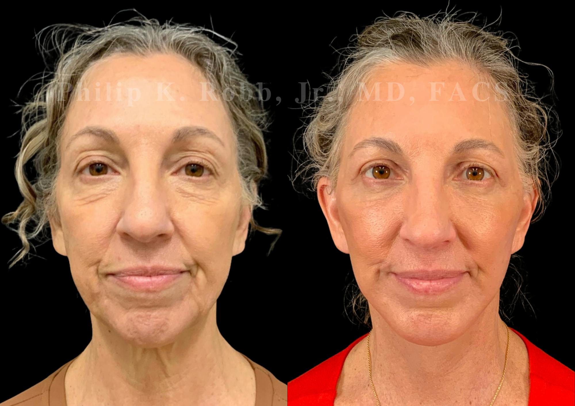 Neck Lift Before & After Gallery - Patient 397586 - Image 4
