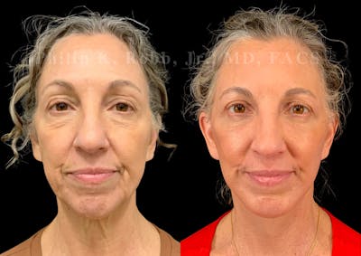 Buccal Fat Reduction Before & After Gallery - Patient 353531 - Image 1