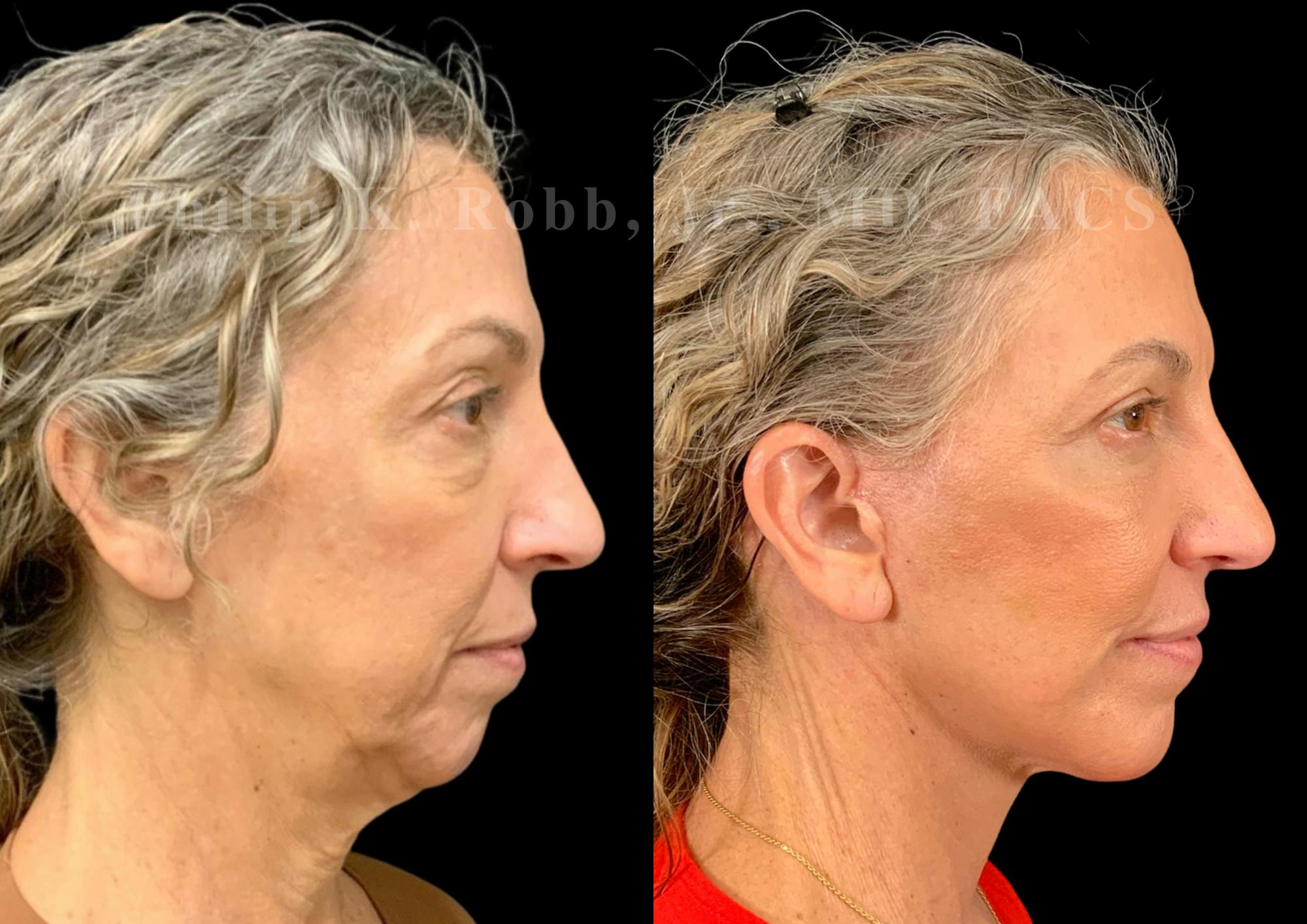 Neck Lift Before & After Gallery - Patient 397586 - Image 6