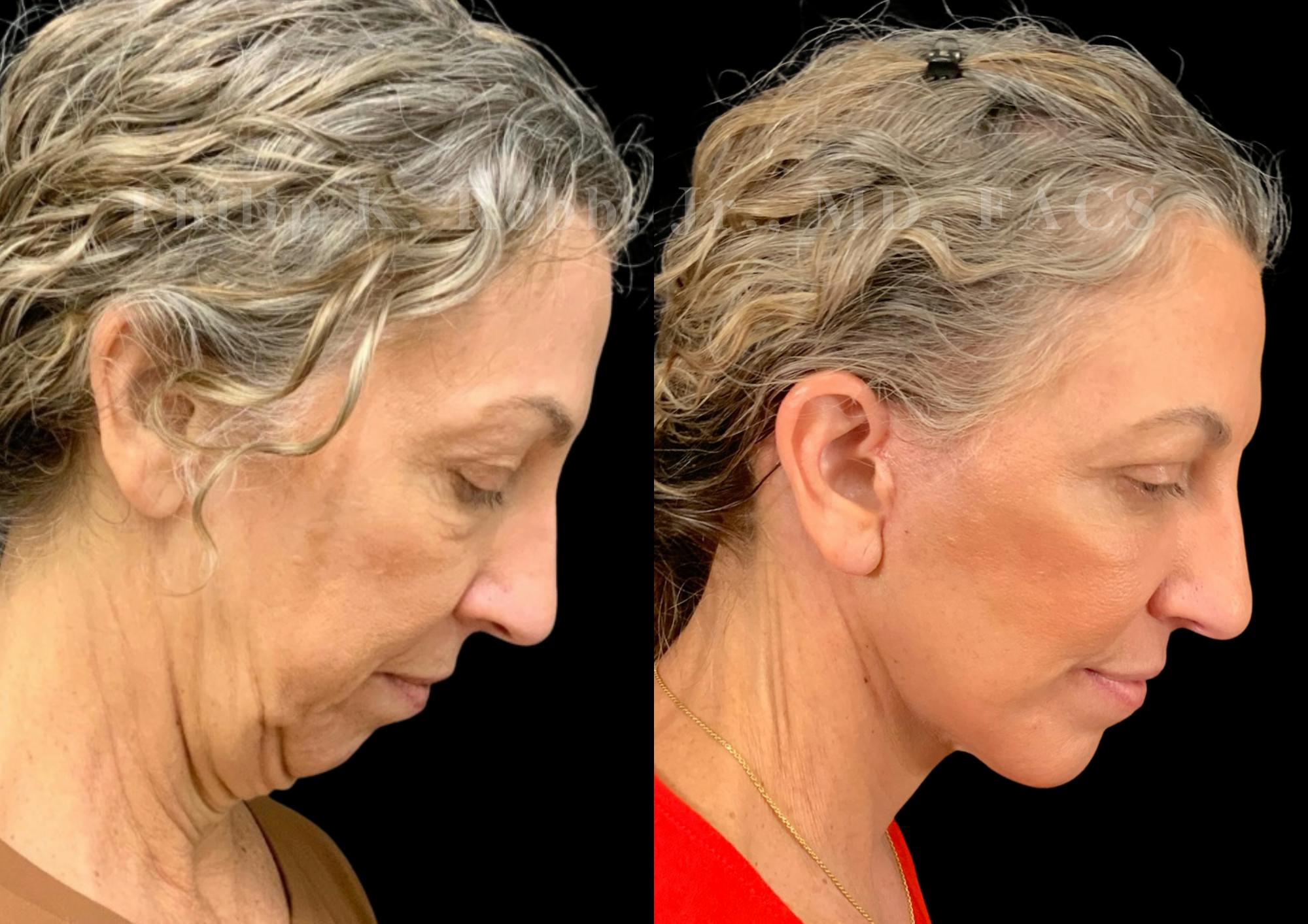Neck Lift Before & After Gallery - Patient 397586 - Image 7