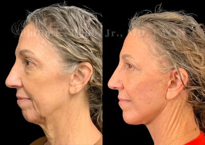 Neck Lift Before & After Gallery - Patient 397586 - Image 1