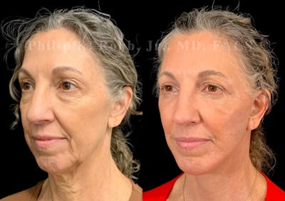 Facelift Before & After Gallery - Patient 312230 - Image 1