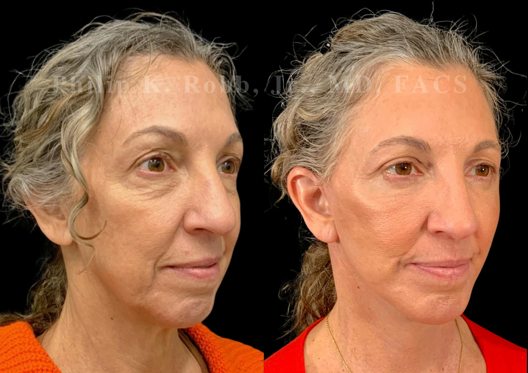 Neck Lift Before & After Gallery - Patient 397586 - Image 5