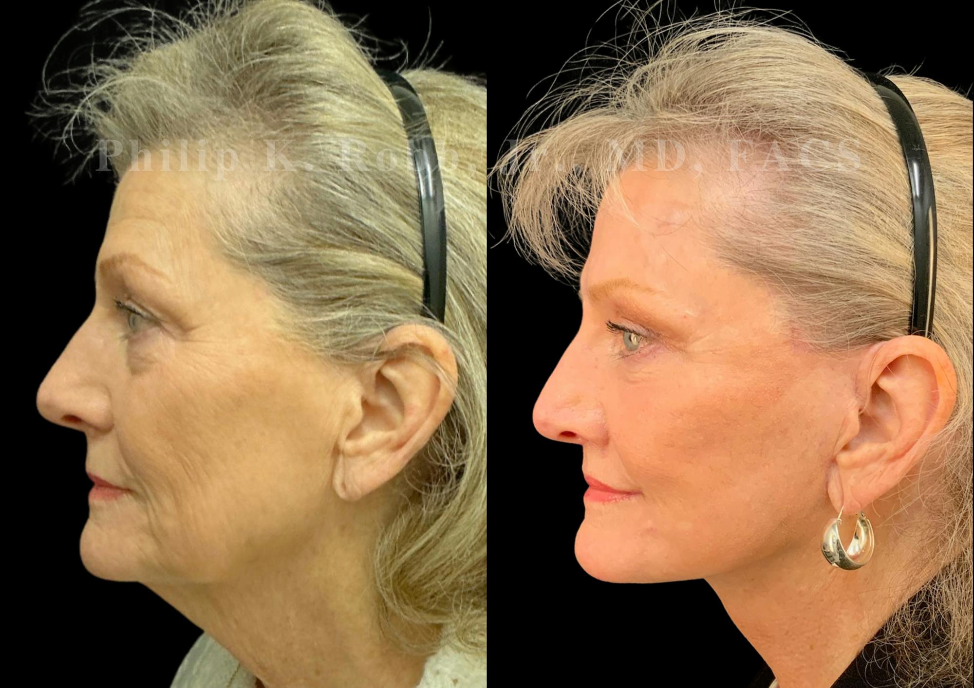 Fat Transfer Before & After Gallery - Patient 190822 - Image 3