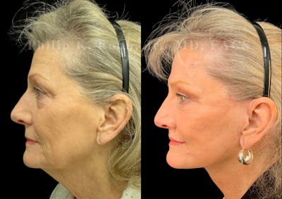 Neck Lift Before & After Gallery - Patient 359269 - Image 1