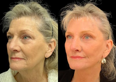 Facelift Before & After Gallery - Patient 490700 - Image 1