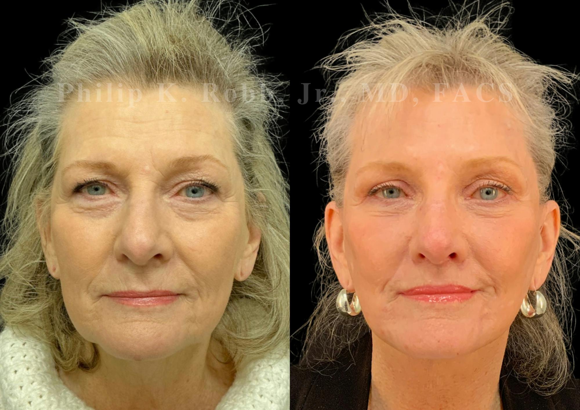 Fat Transfer Before & After Gallery - Patient 190822 - Image 1