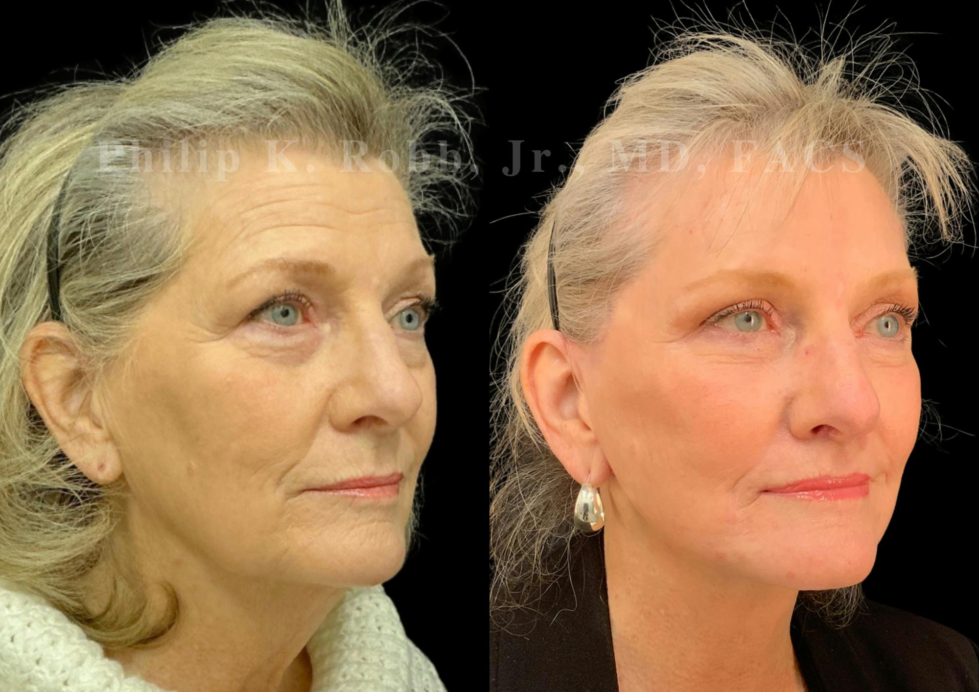 Fat Transfer Before & After Gallery - Patient 190822 - Image 5