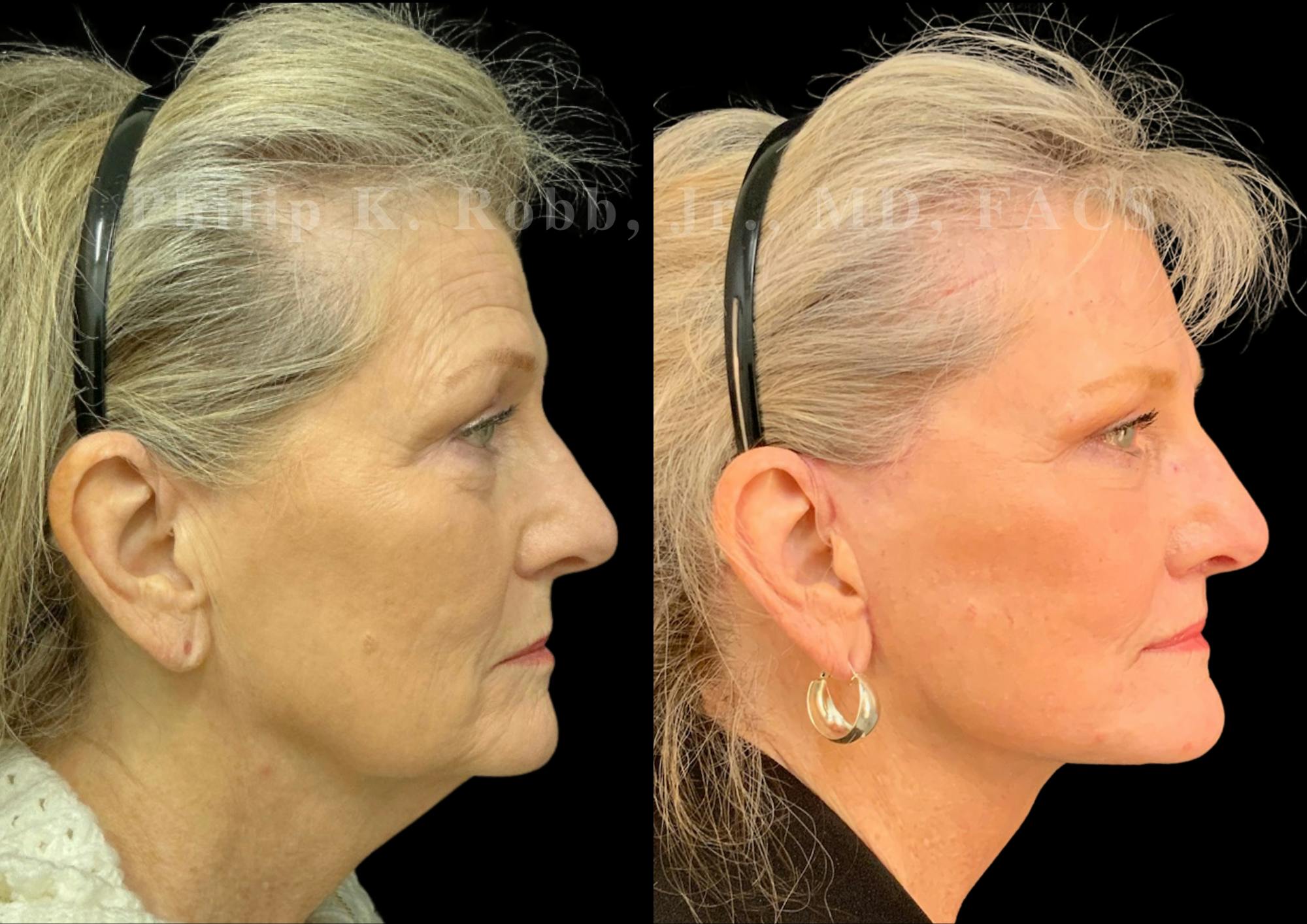 Fat Transfer Before & After Gallery - Patient 190822 - Image 6