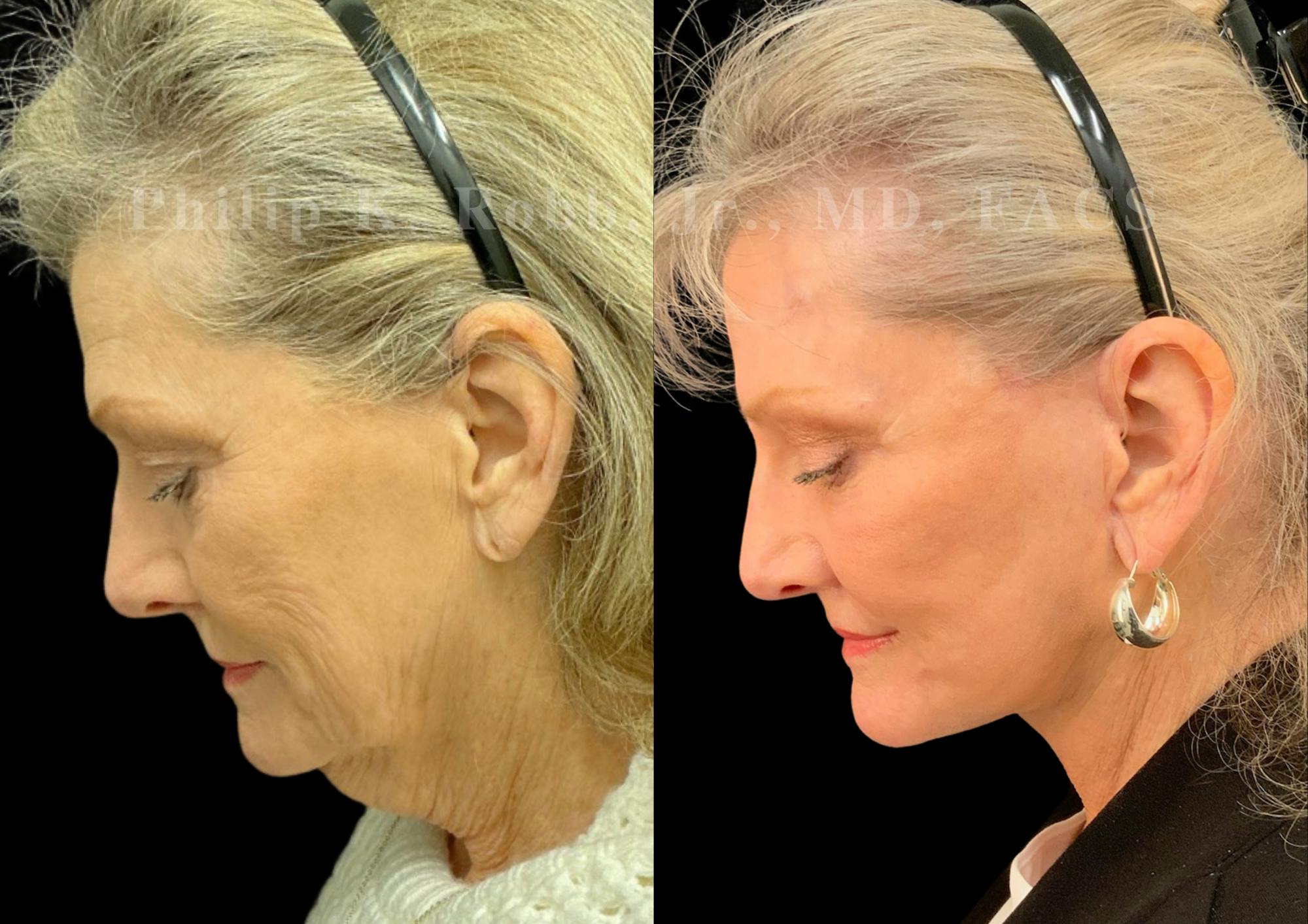 Fat Transfer Before & After Gallery - Patient 190822 - Image 2