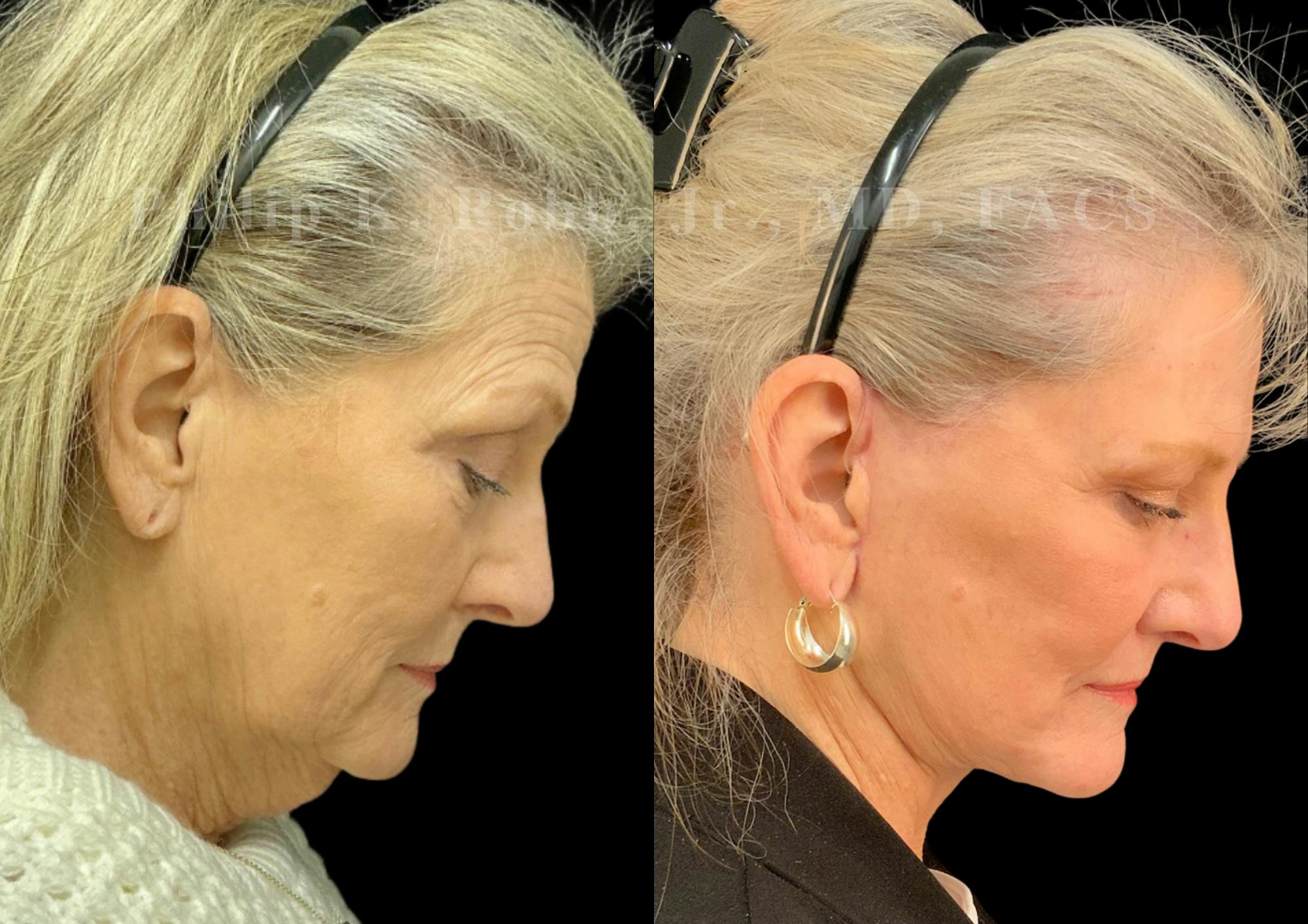 Fat Transfer Before & After Gallery - Patient 190822 - Image 7