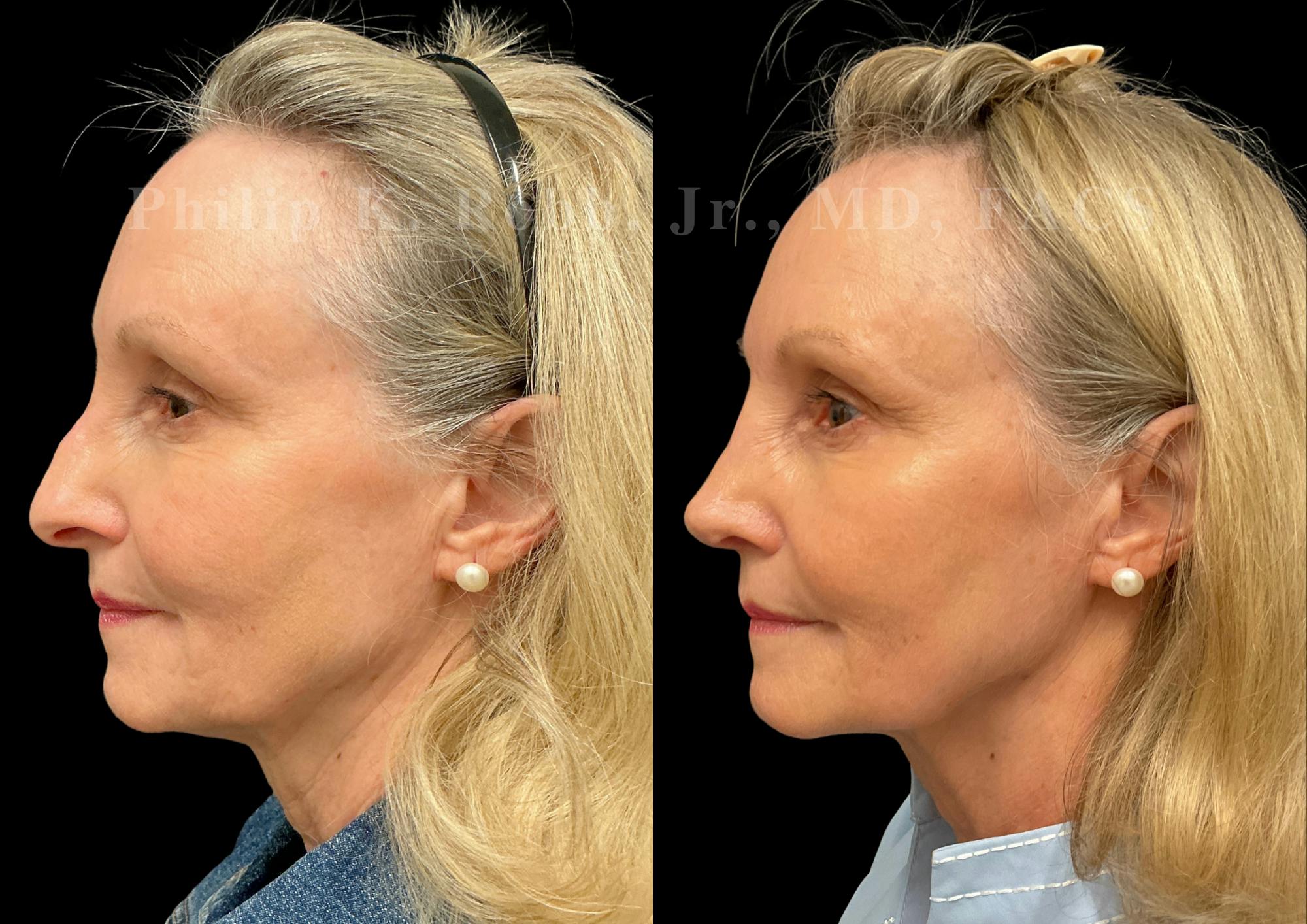 Ultrasonic Rhinoplasty Before & After Gallery - Patient 101076 - Image 5
