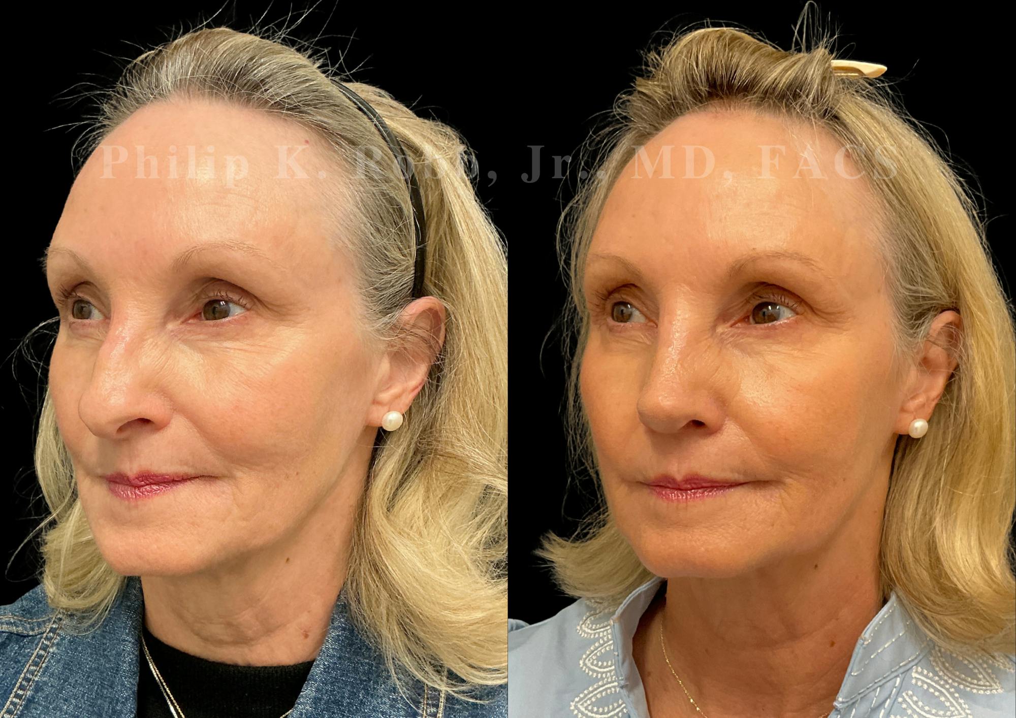 Ultrasonic Rhinoplasty Before & After Gallery - Patient 101076 - Image 4