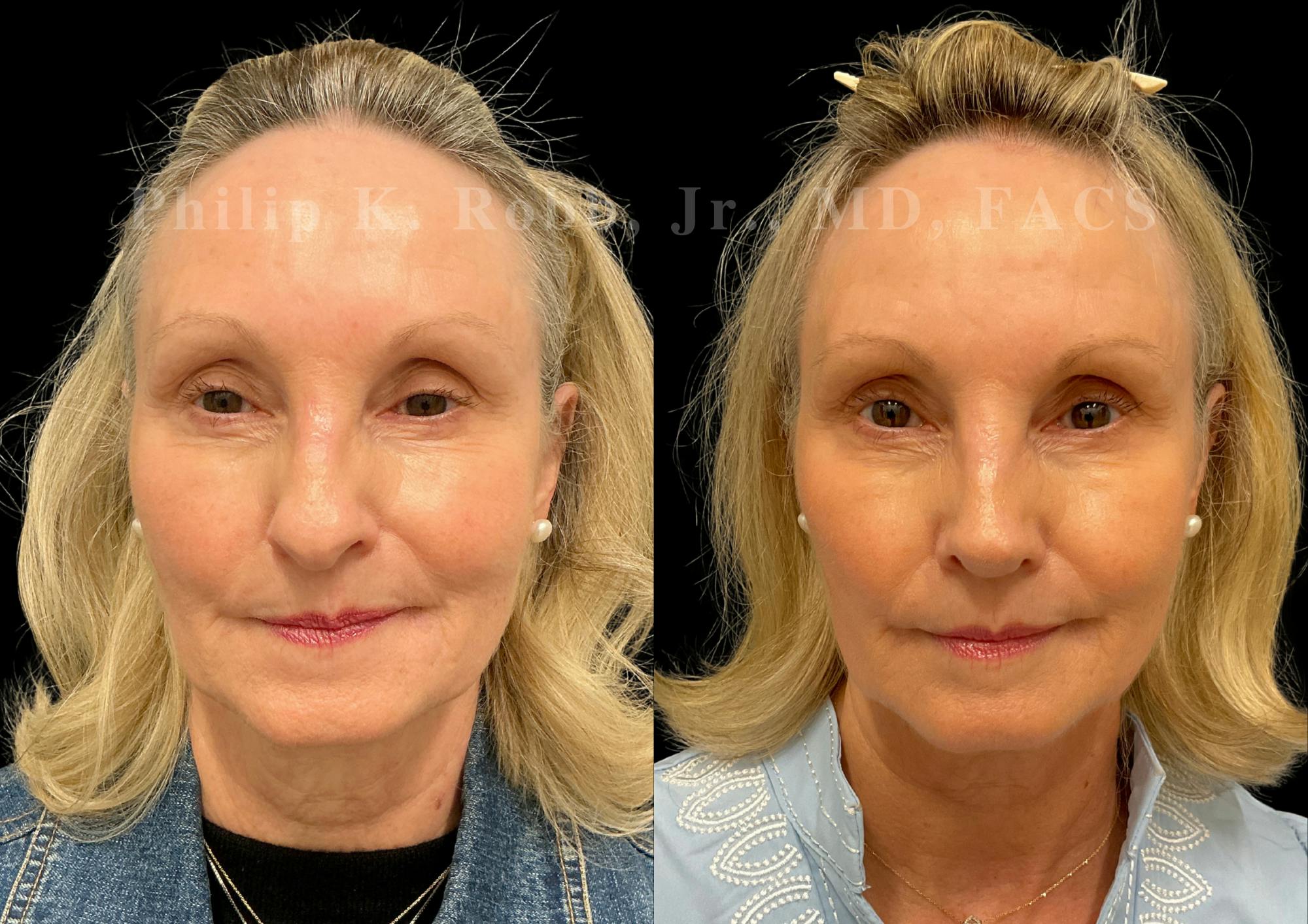Ultrasonic Rhinoplasty Before & After Gallery - Patient 101076 - Image 3