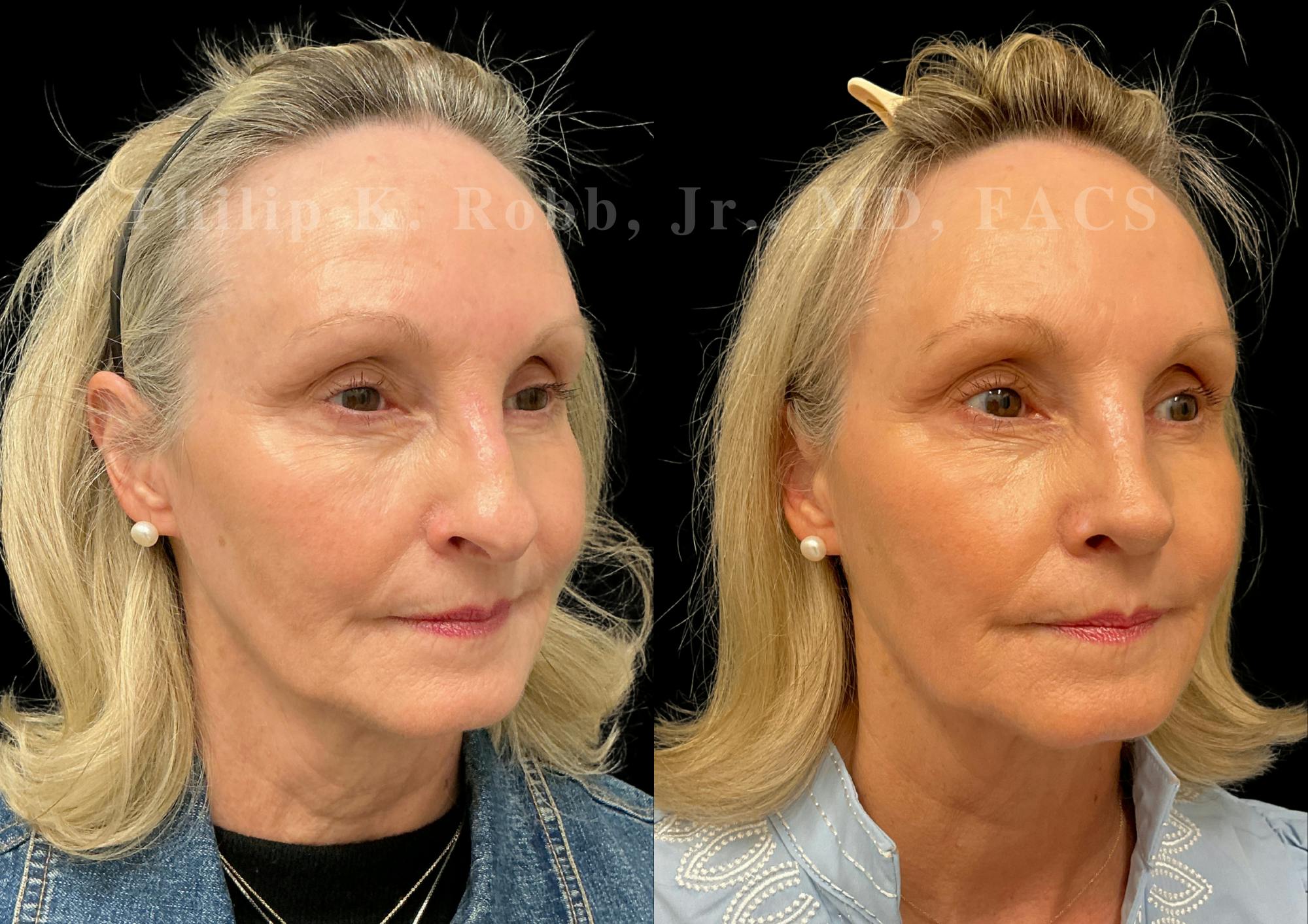 Ultrasonic Rhinoplasty Before & After Gallery - Patient 101076 - Image 2