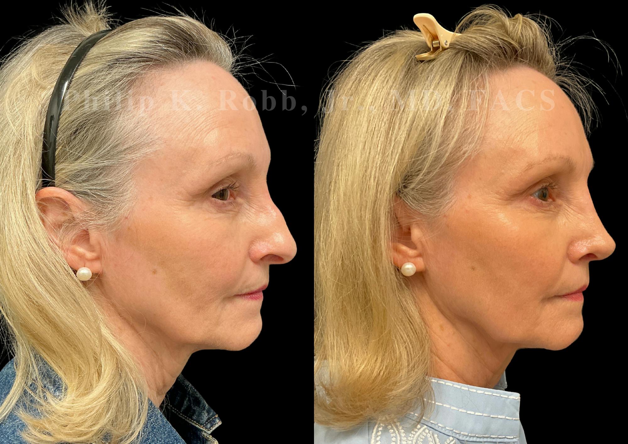 Ultrasonic Rhinoplasty Before & After Gallery - Patient 101076 - Image 1
