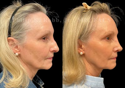 Ultrasonic Rhinoplasty Before & After Gallery - Patient 101076 - Image 1