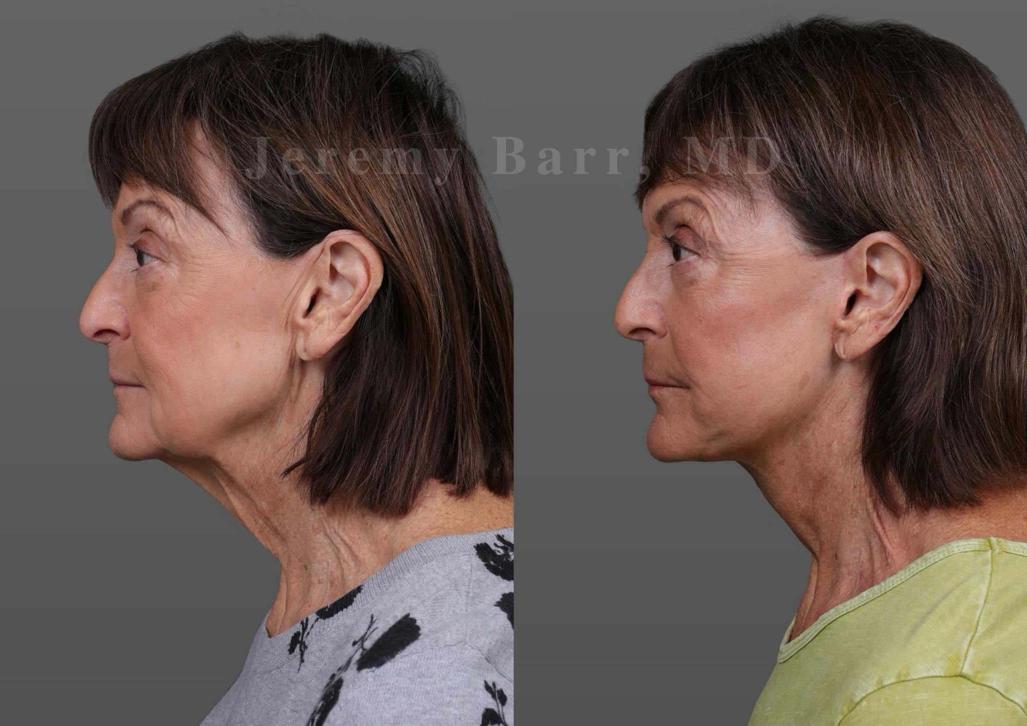 Jeremy Barr, MD Before and After