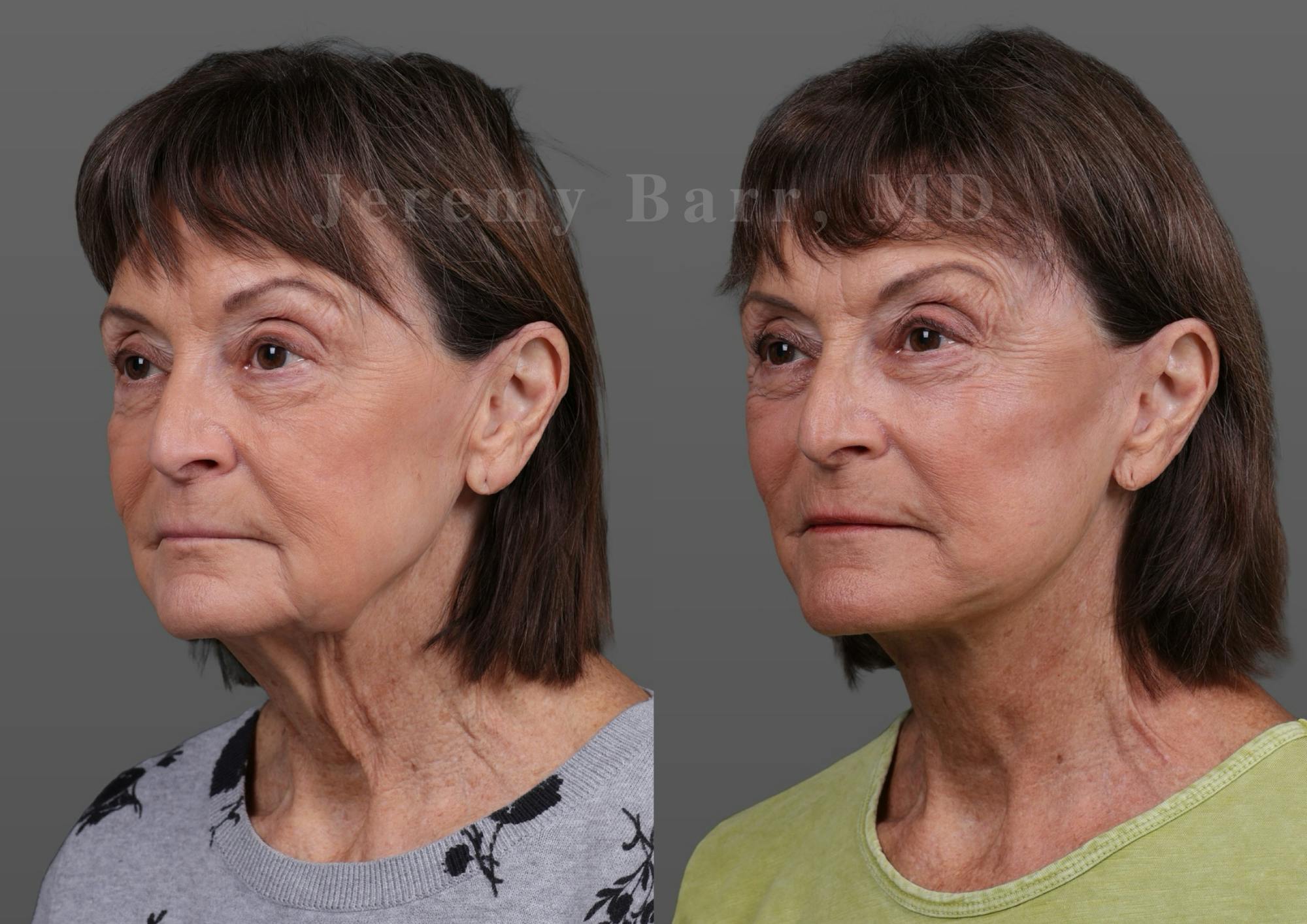 Jeremy Barr, MD Before and After