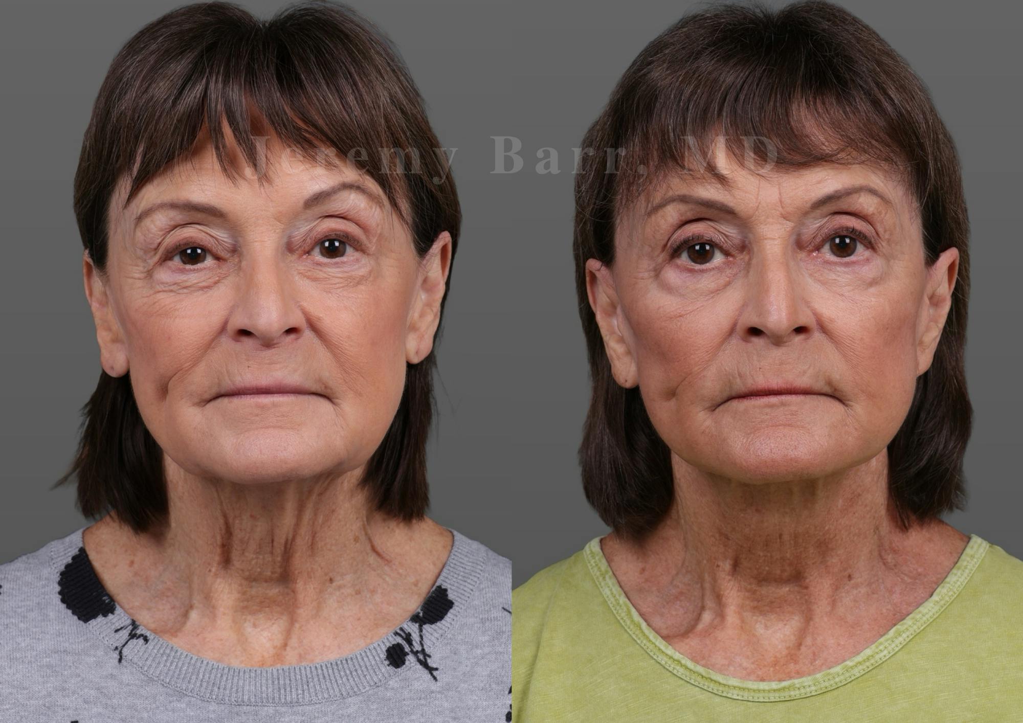 Jeremy Barr, MD Before and After