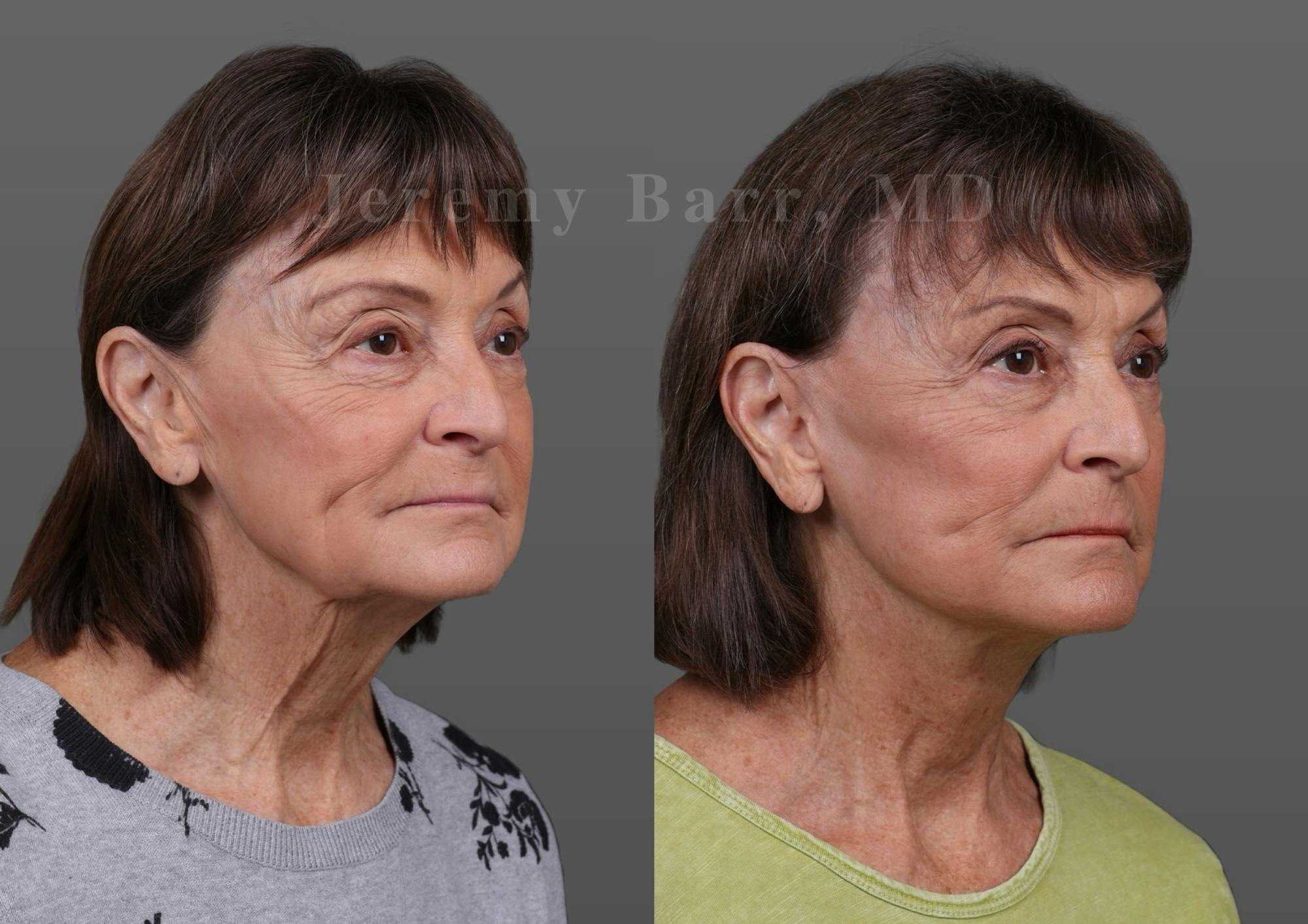 Jeremy Barr, MD Before and After