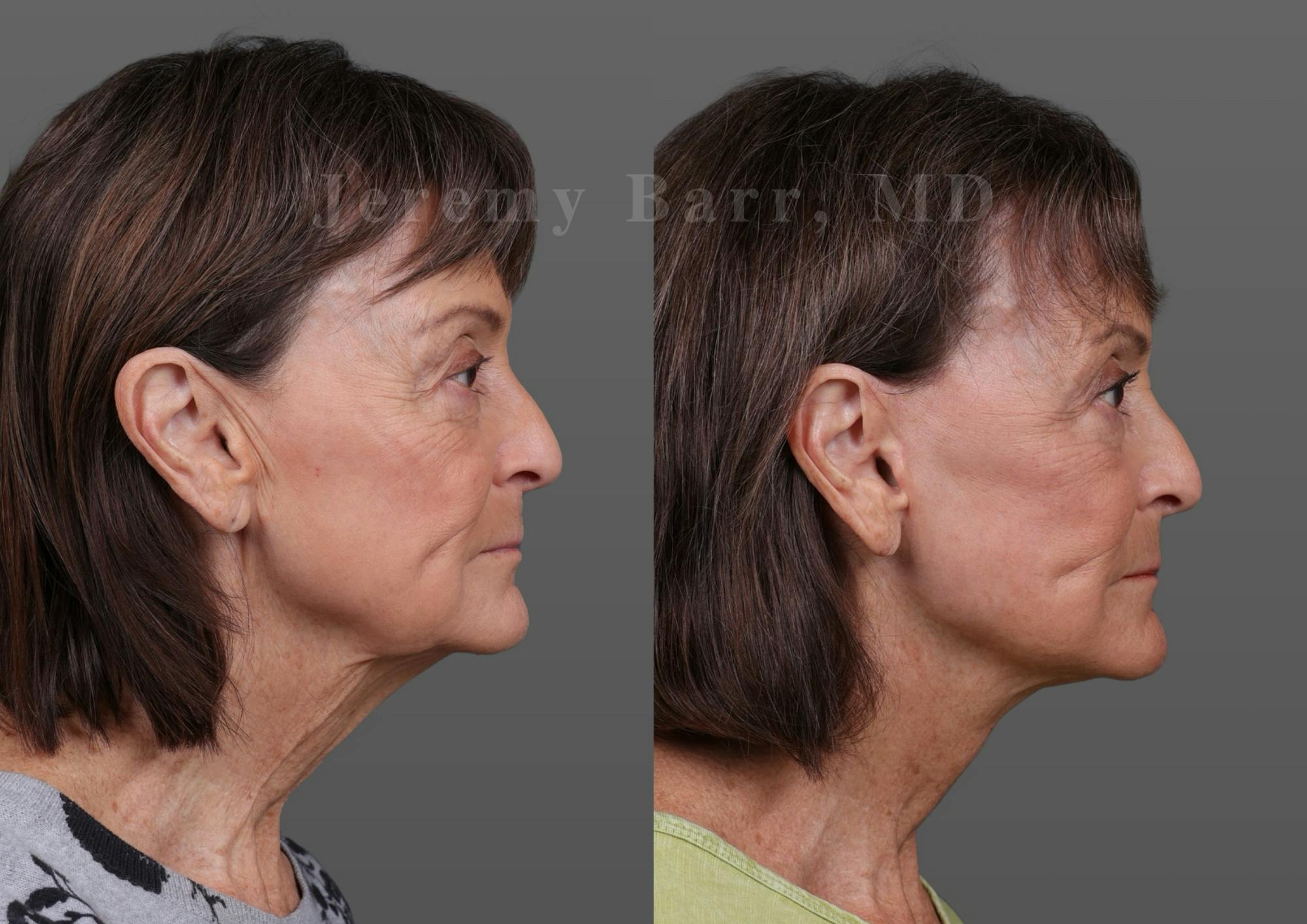 Jeremy Barr, MD Before and After