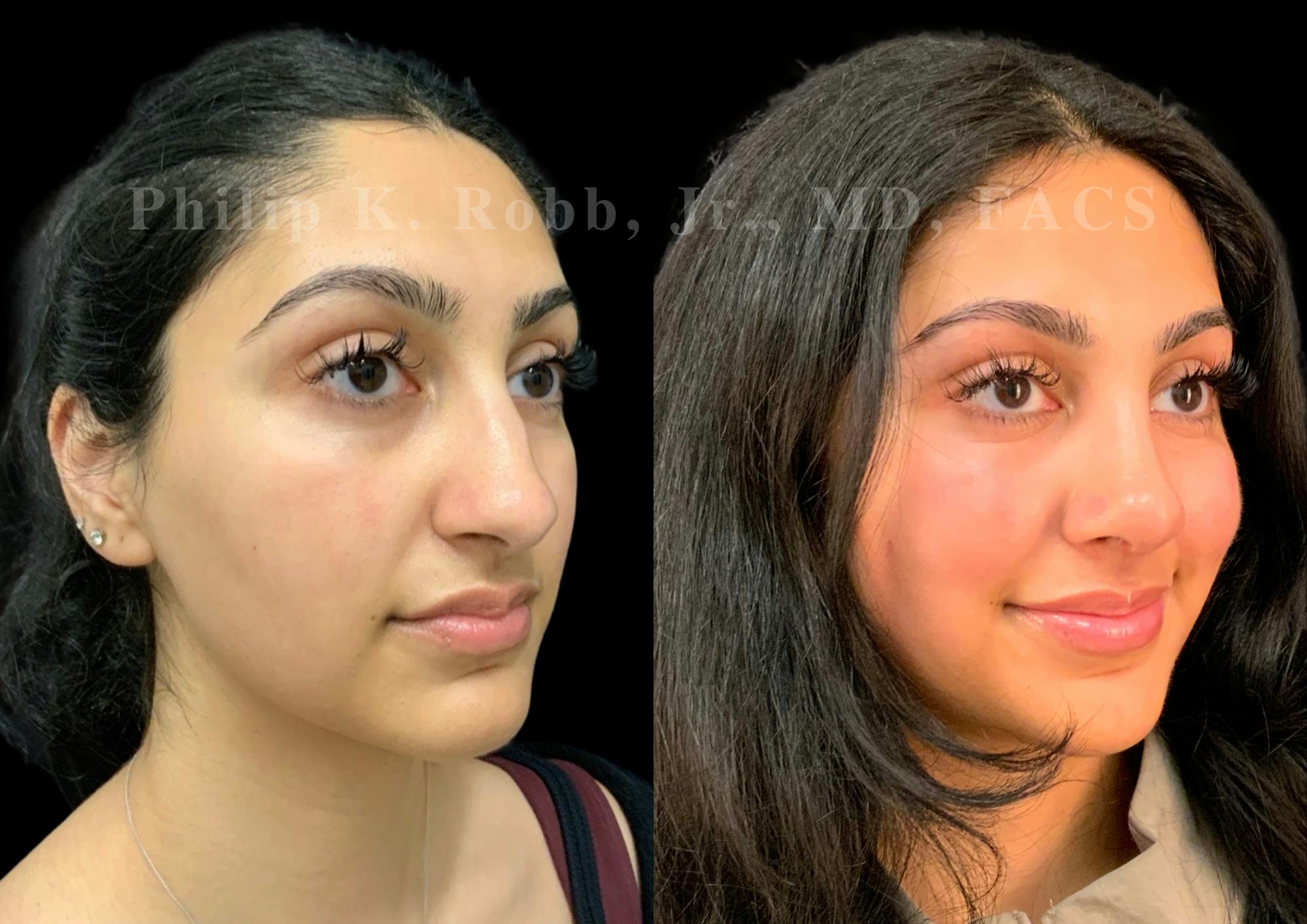 Ultrasonic Rhinoplasty Before & After Gallery - Patient 266729 - Image 2