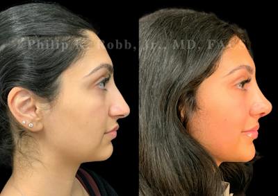 Ultrasonic Rhinoplasty Before & After Gallery - Patient 266729 - Image 1