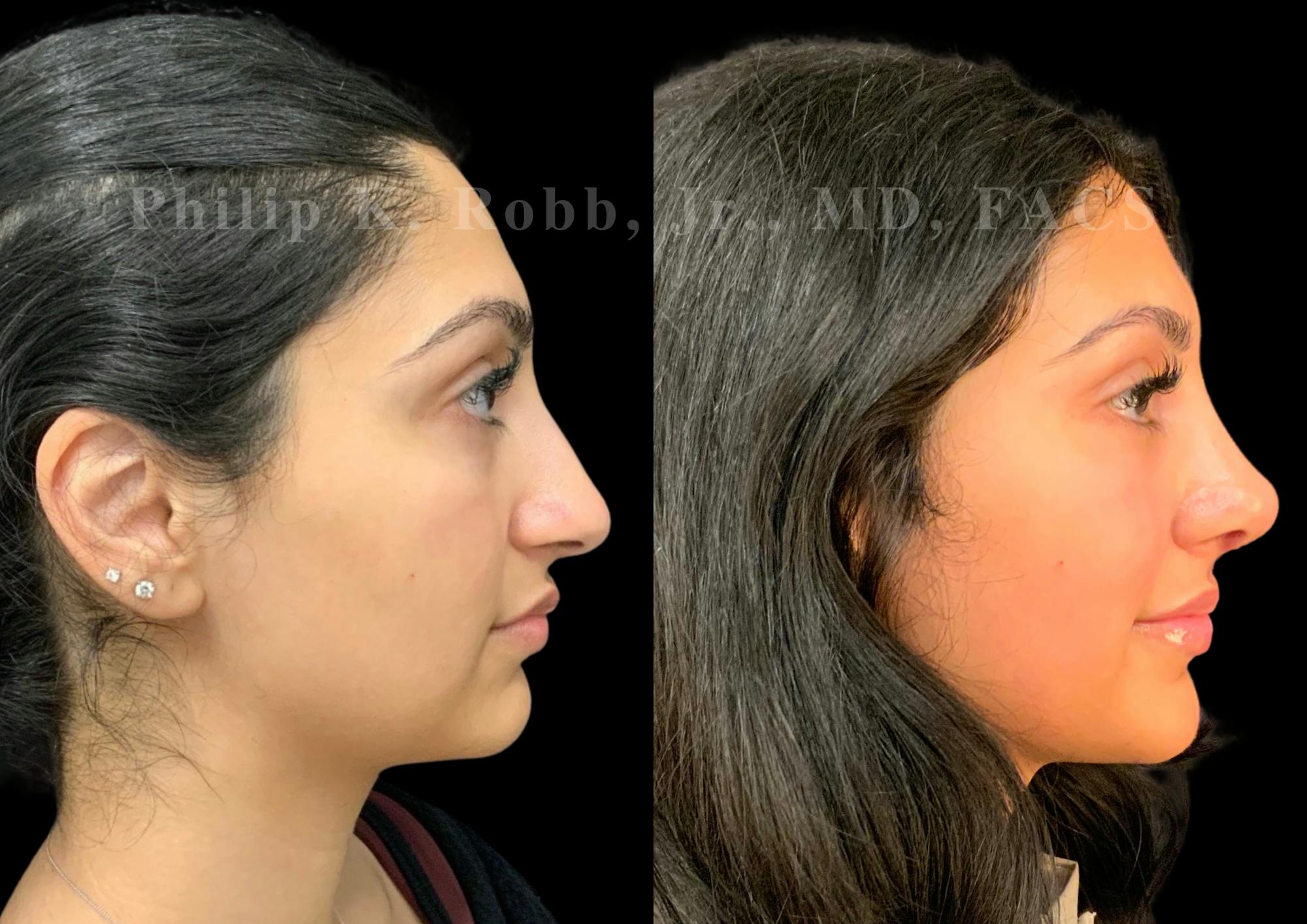 Ultrasonic Rhinoplasty Before & After Gallery - Patient 266729 - Image 1