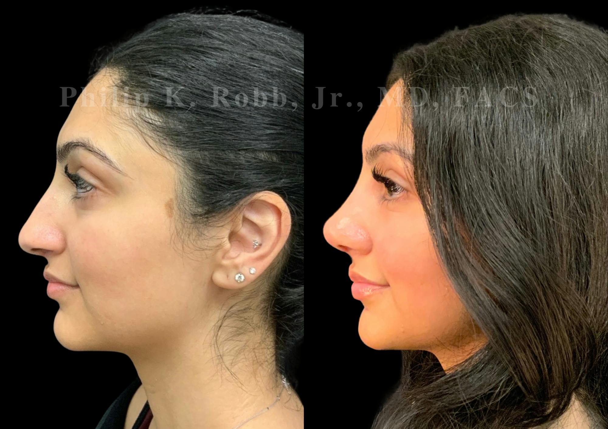 Ultrasonic Rhinoplasty Before & After Gallery - Patient 266729 - Image 5