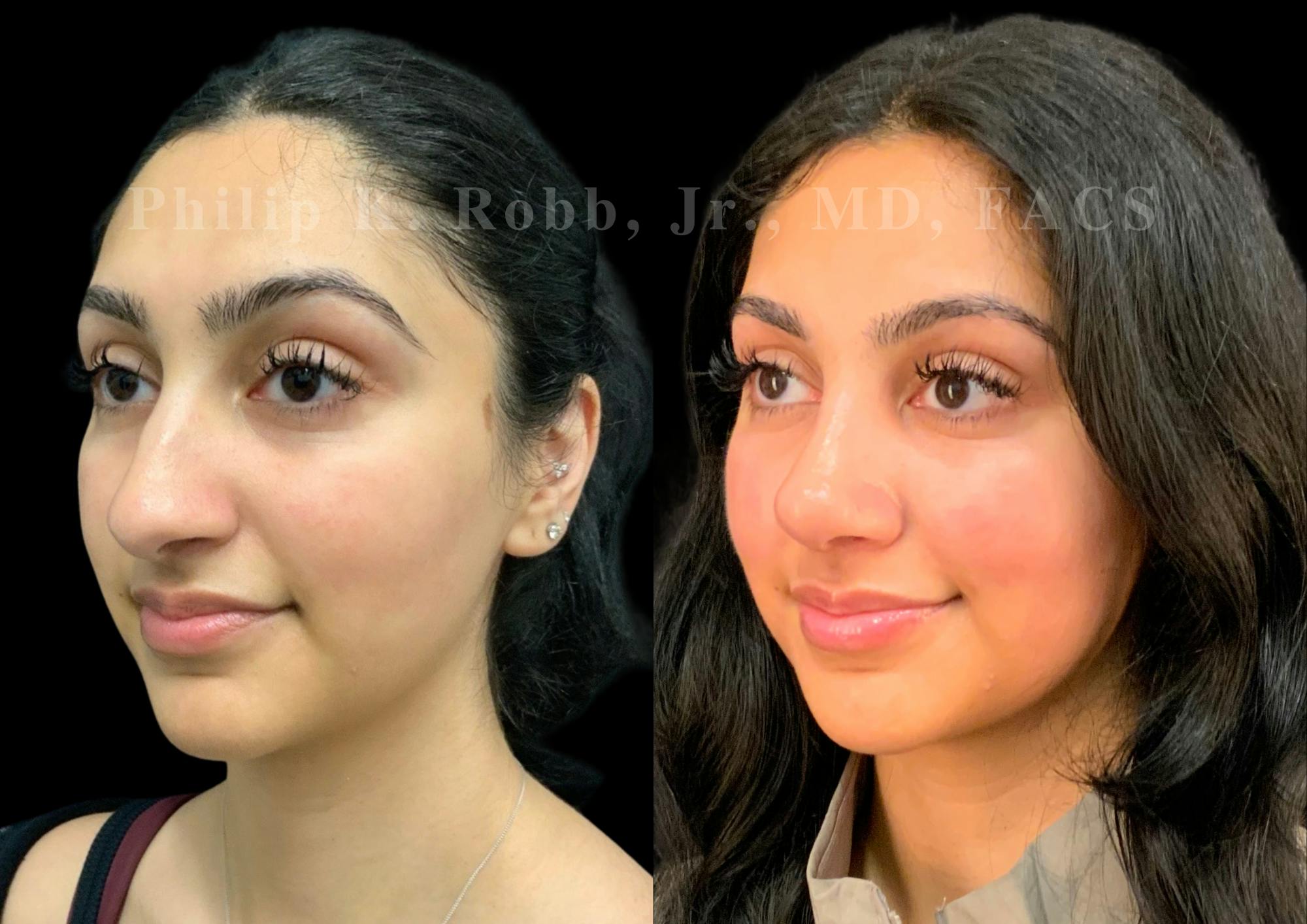 Ultrasonic Rhinoplasty Before & After Gallery - Patient 266729 - Image 4