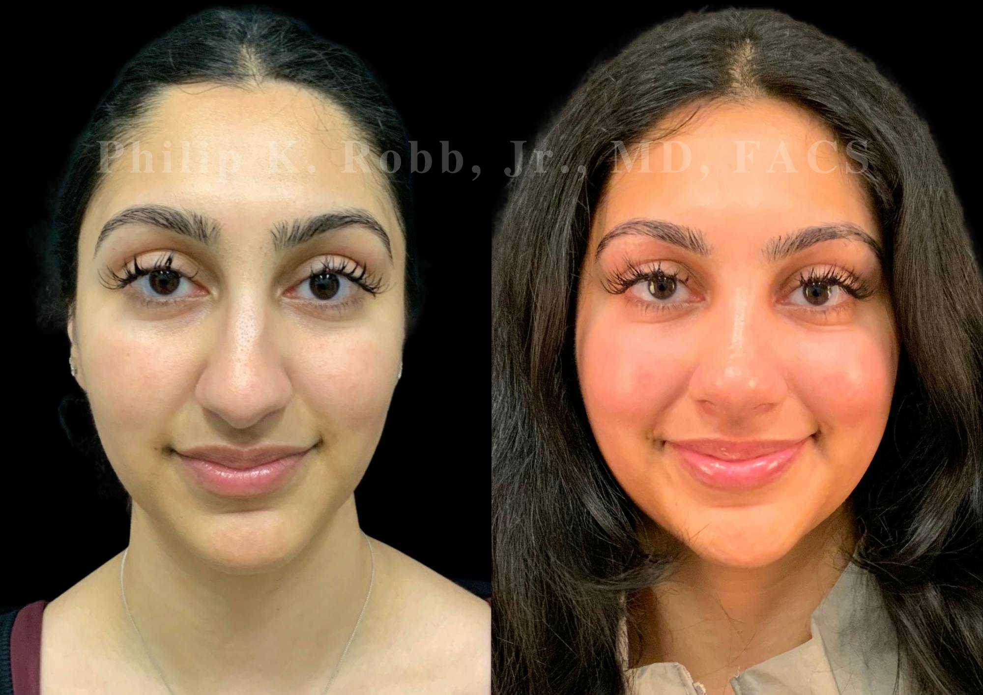 Ultrasonic Rhinoplasty Before & After Gallery - Patient 266729 - Image 3