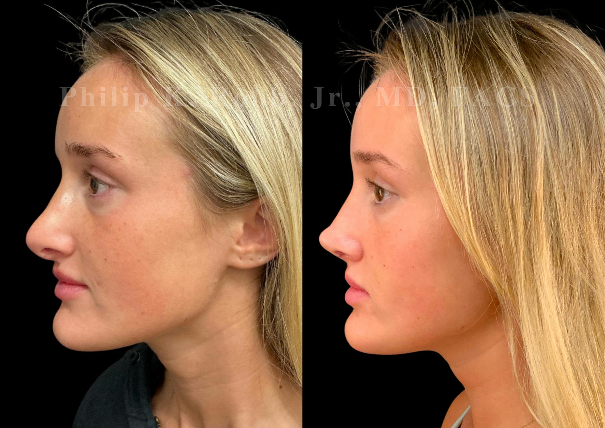 Ultrasonic Rhinoplasty Before & After Gallery - Patient 247667 - Image 5