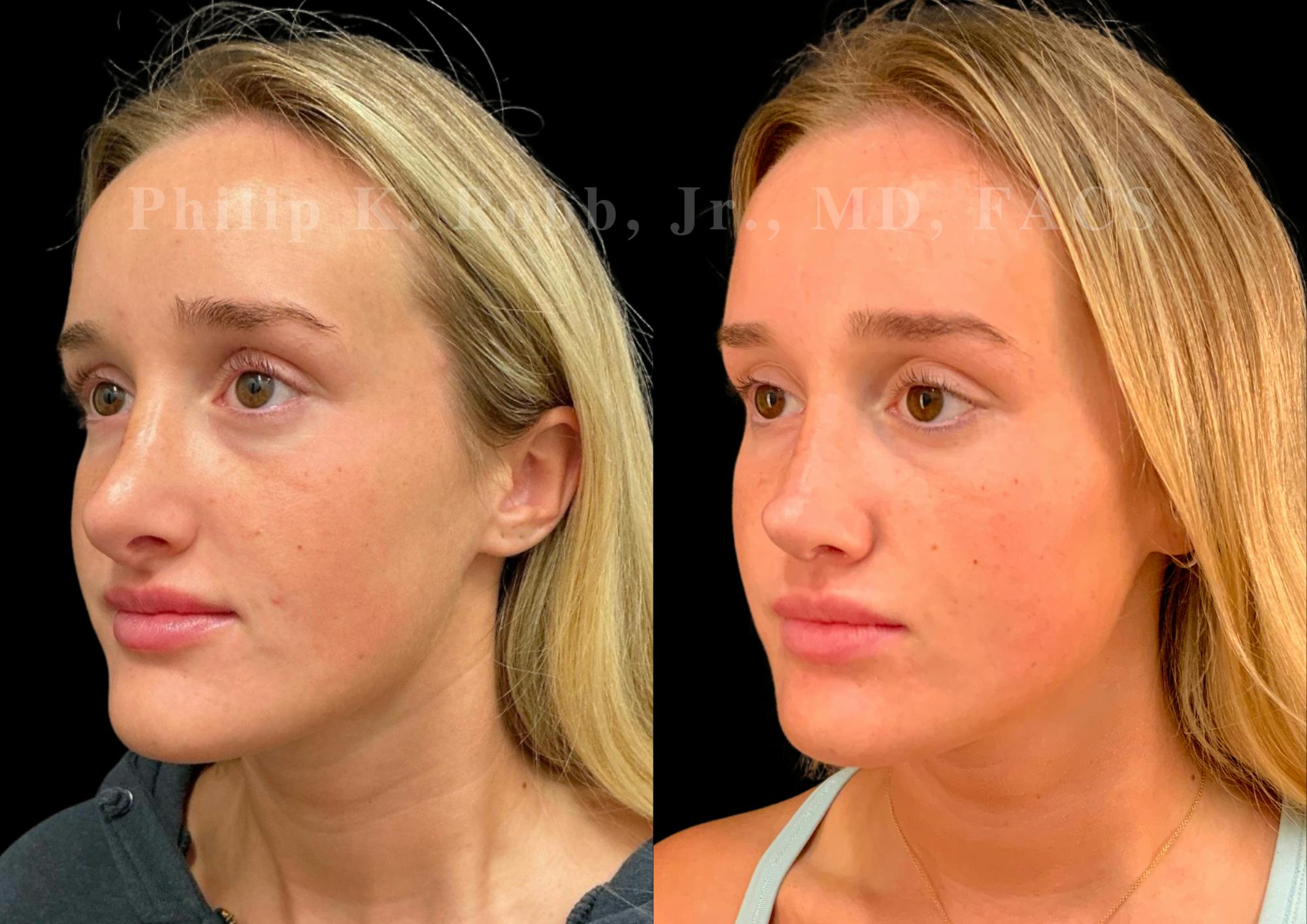 Ultrasonic Rhinoplasty Before & After Gallery - Patient 247667 - Image 4