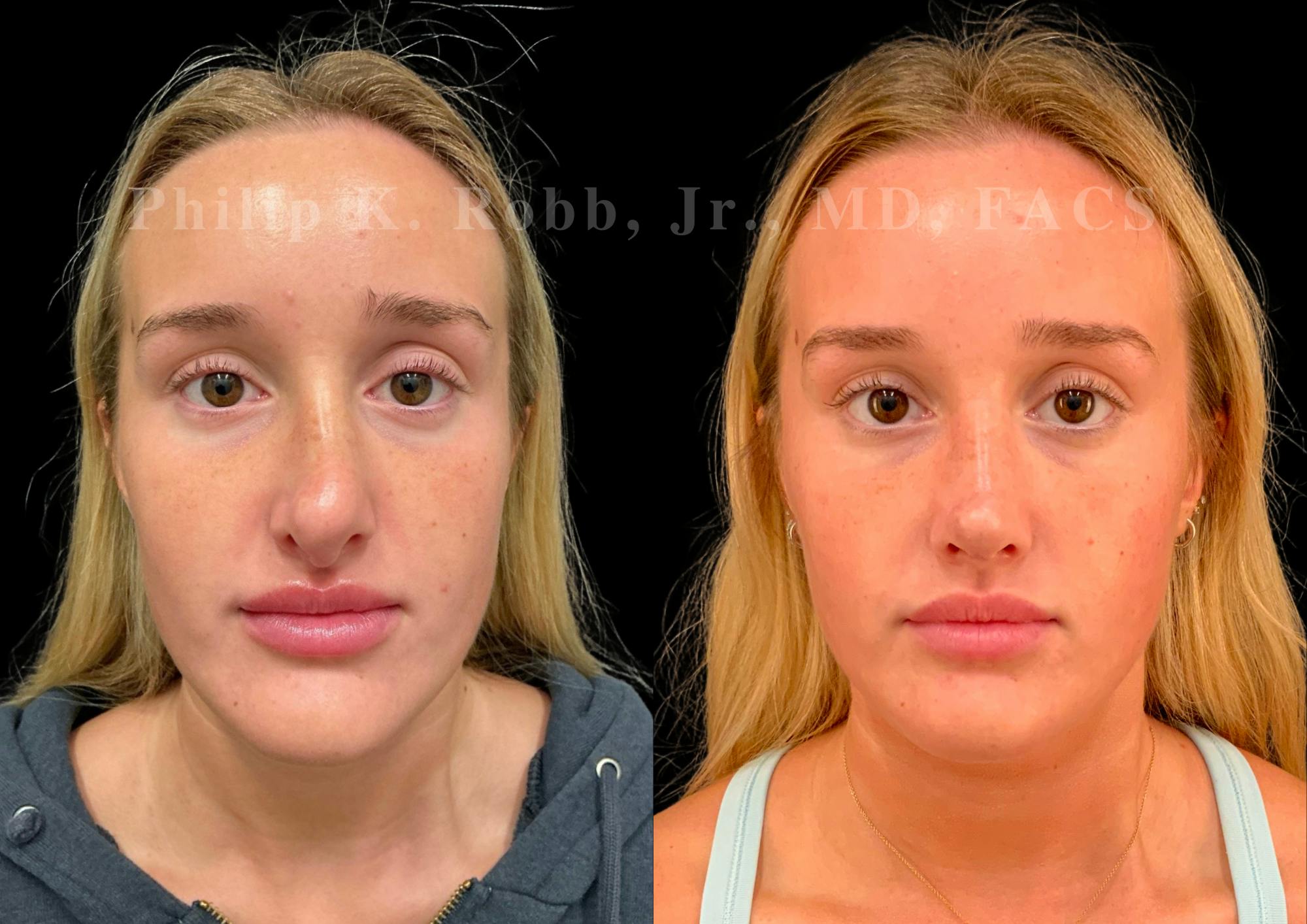 Ultrasonic Rhinoplasty Before & After Gallery - Patient 247667 - Image 3