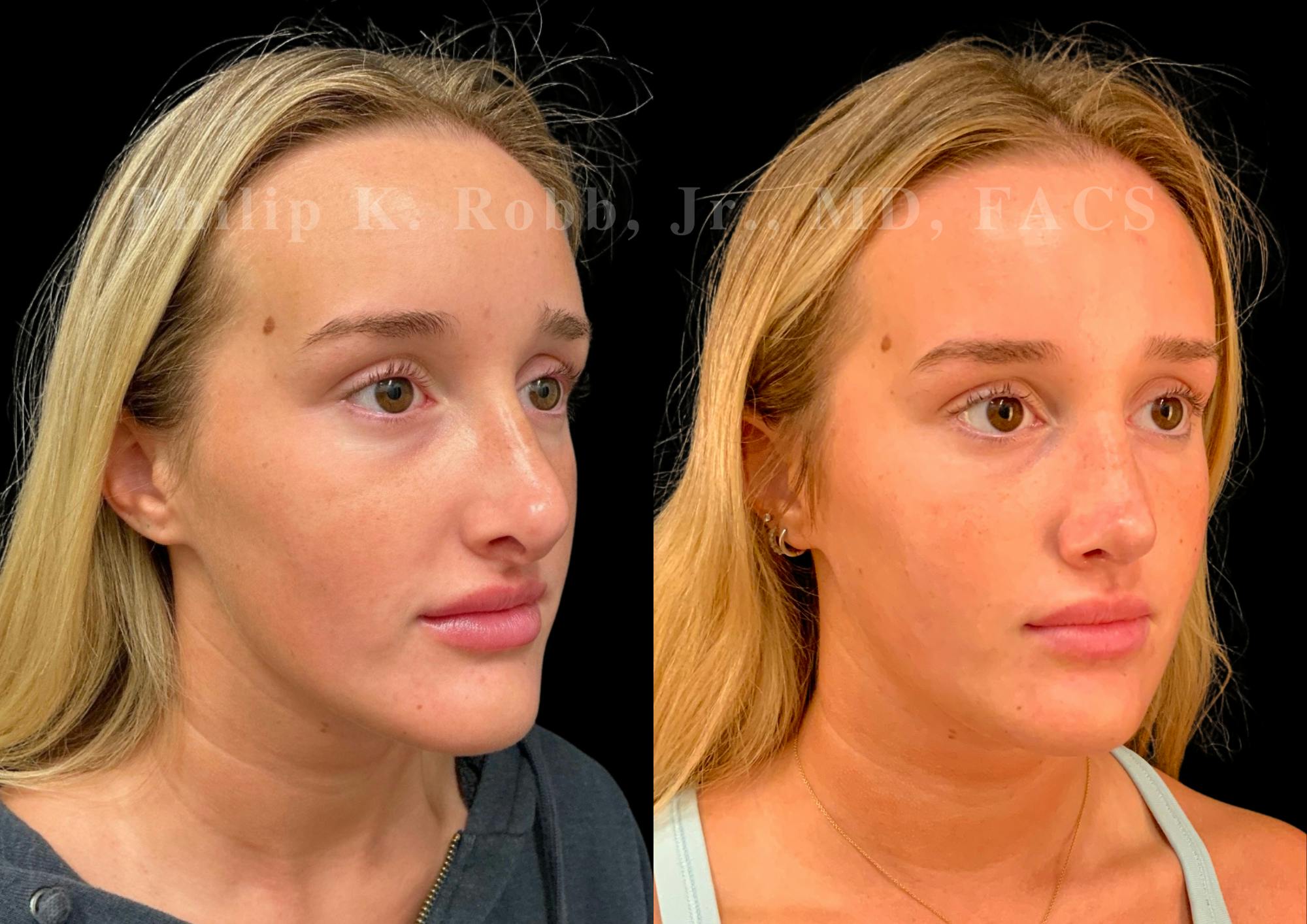 Ultrasonic Rhinoplasty Before & After Gallery - Patient 247667 - Image 2
