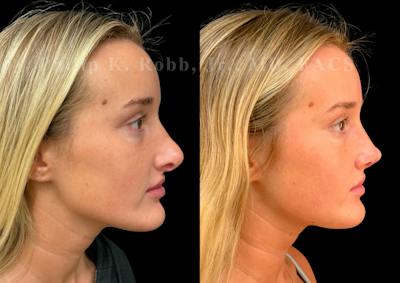 Ultrasonic Rhinoplasty Before & After Gallery - Patient 247667 - Image 1