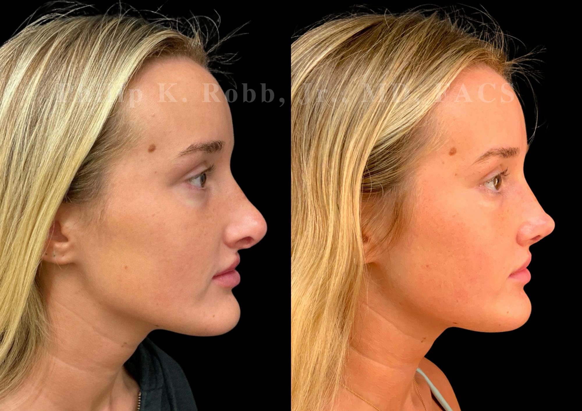 Ultrasonic Rhinoplasty Before & After Gallery - Patient 247667 - Image 1