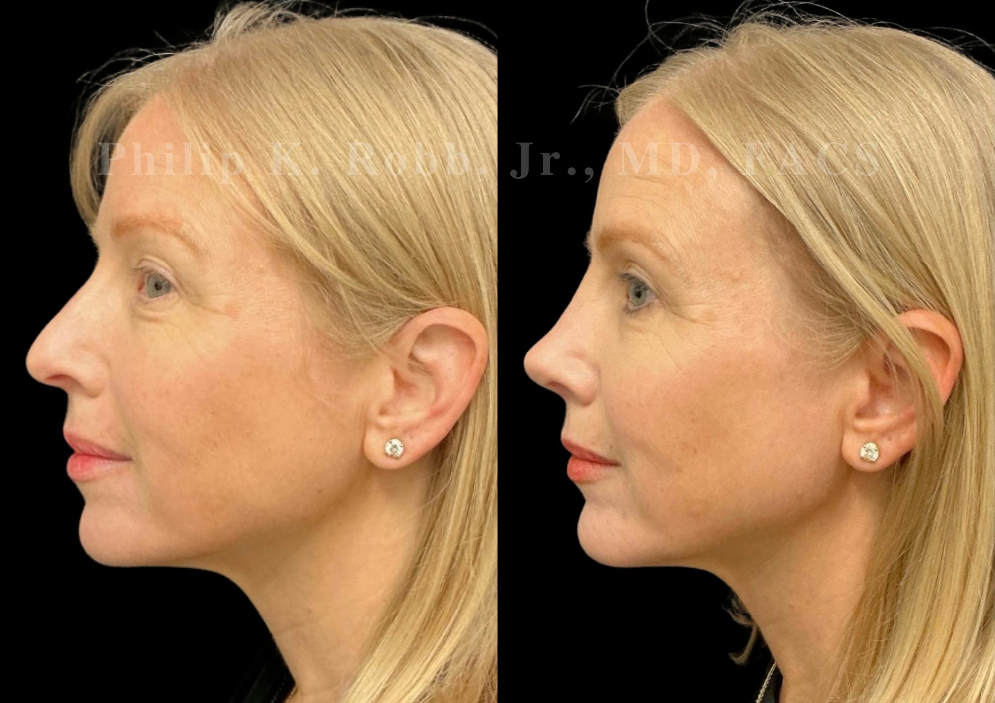 Ultrasonic Rhinoplasty Before & After Gallery - Patient 403331 - Image 5