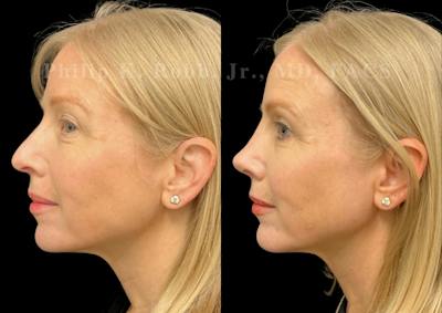 Chin Augmentation Before & After Gallery - Patient 389477 - Image 1