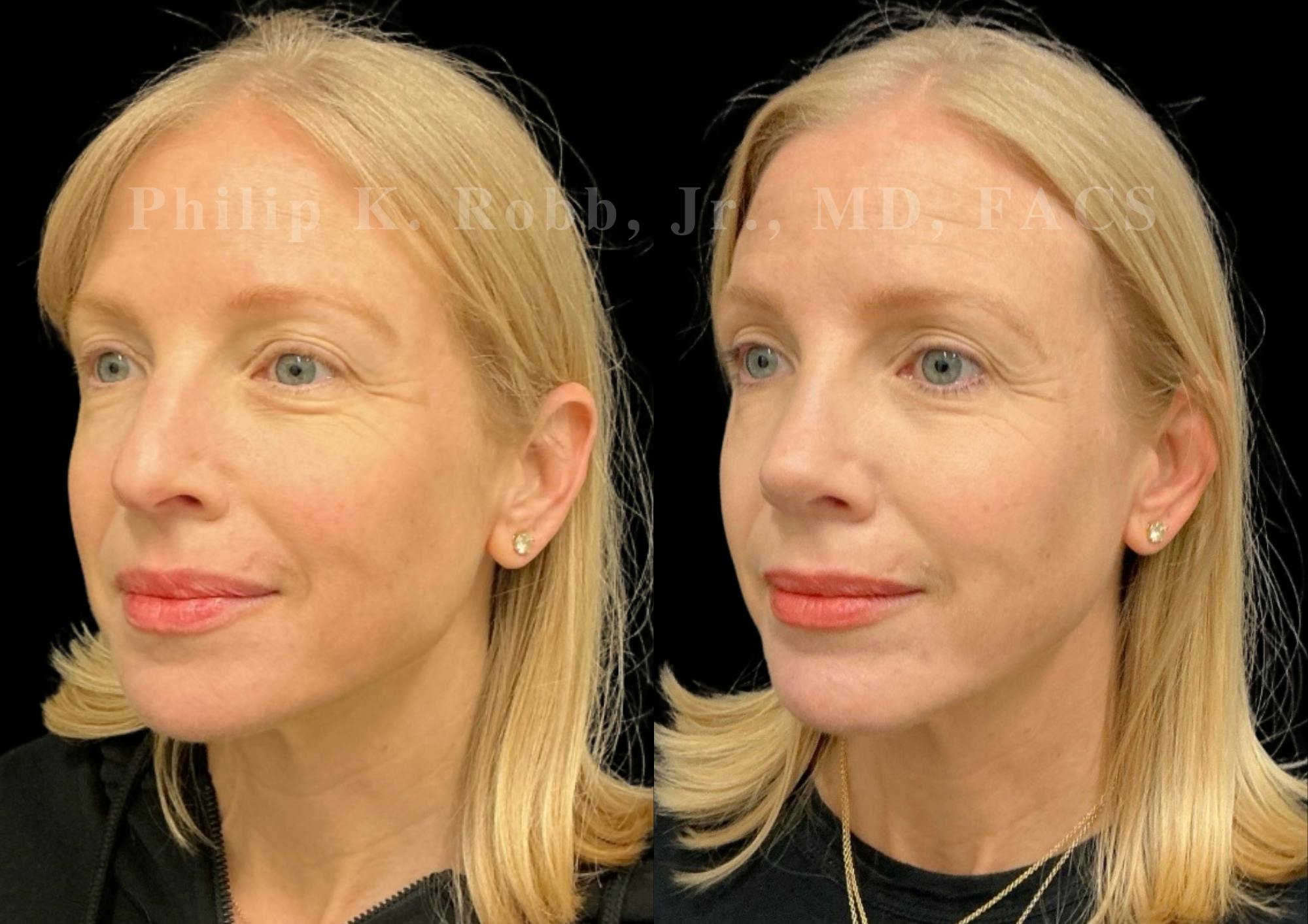 Ultrasonic Rhinoplasty Before & After Gallery - Patient 403331 - Image 4