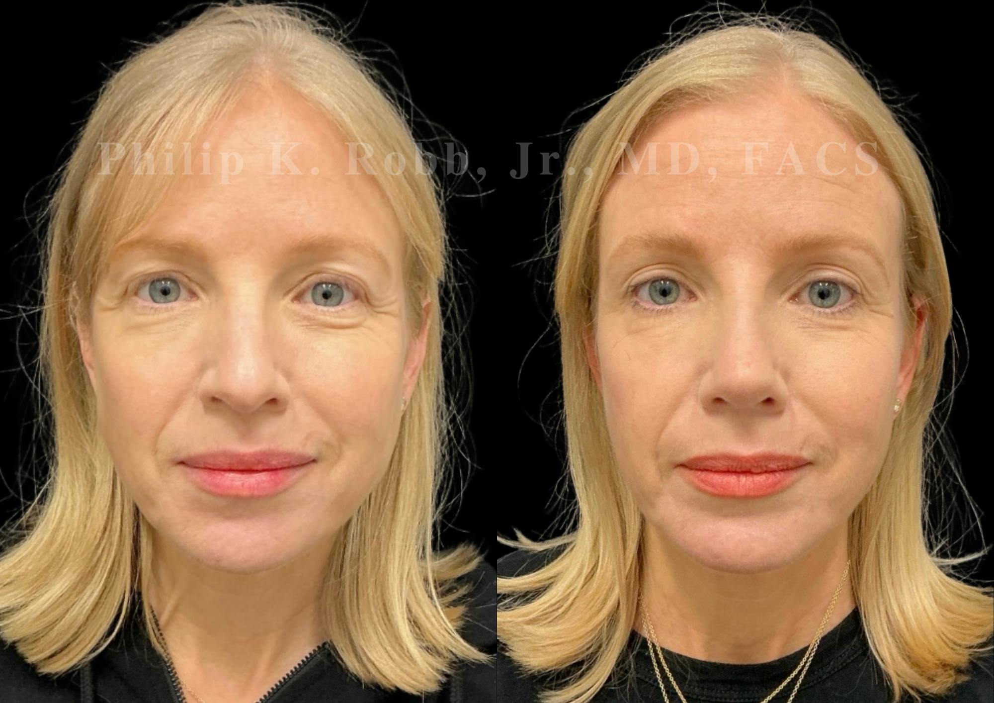 Ultrasonic Rhinoplasty Before & After Gallery - Patient 403331 - Image 3