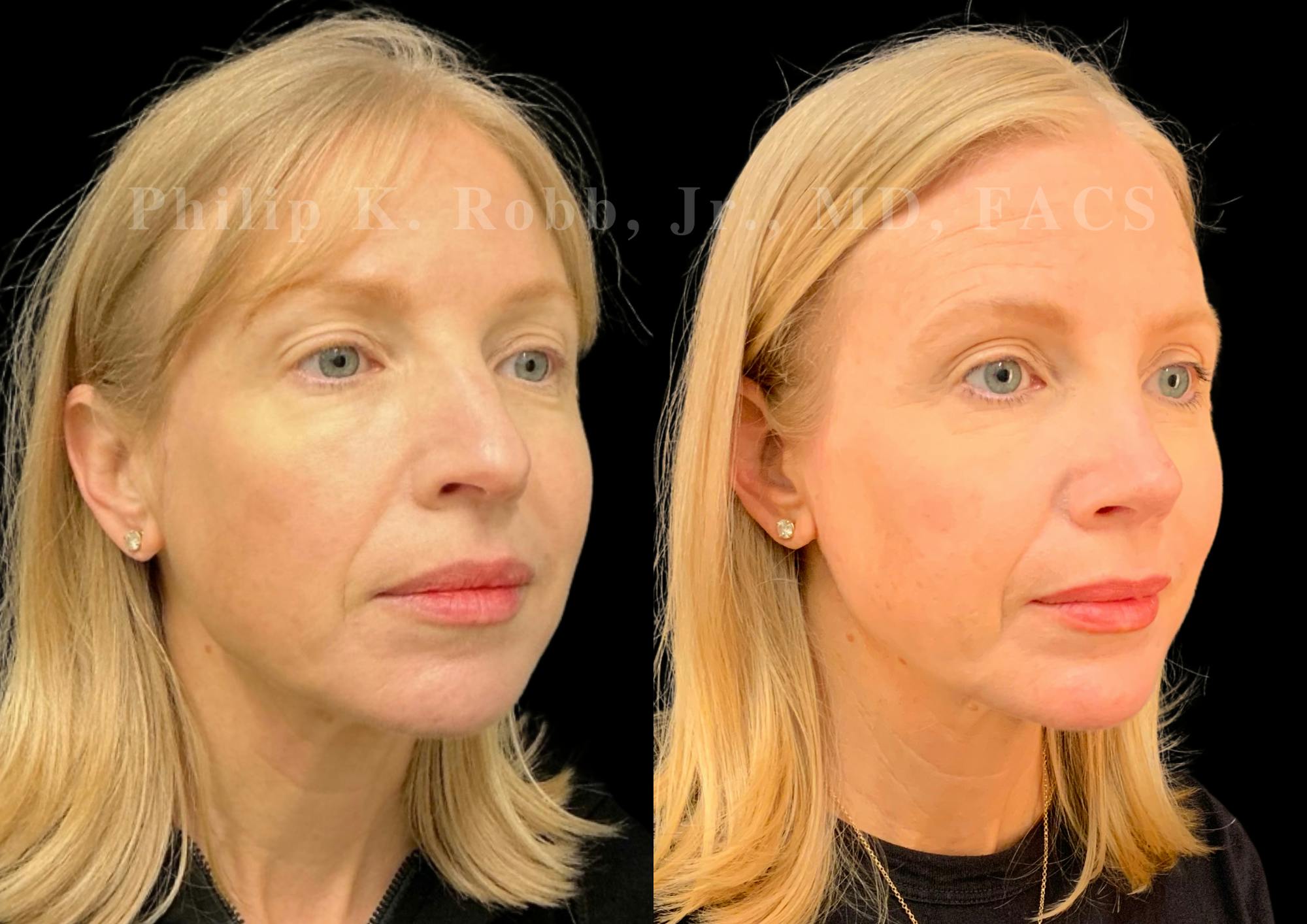 Ultrasonic Rhinoplasty Before & After Gallery - Patient 403331 - Image 2