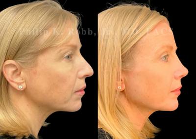 Ultrasonic Rhinoplasty Before & After Gallery - Patient 403331 - Image 1