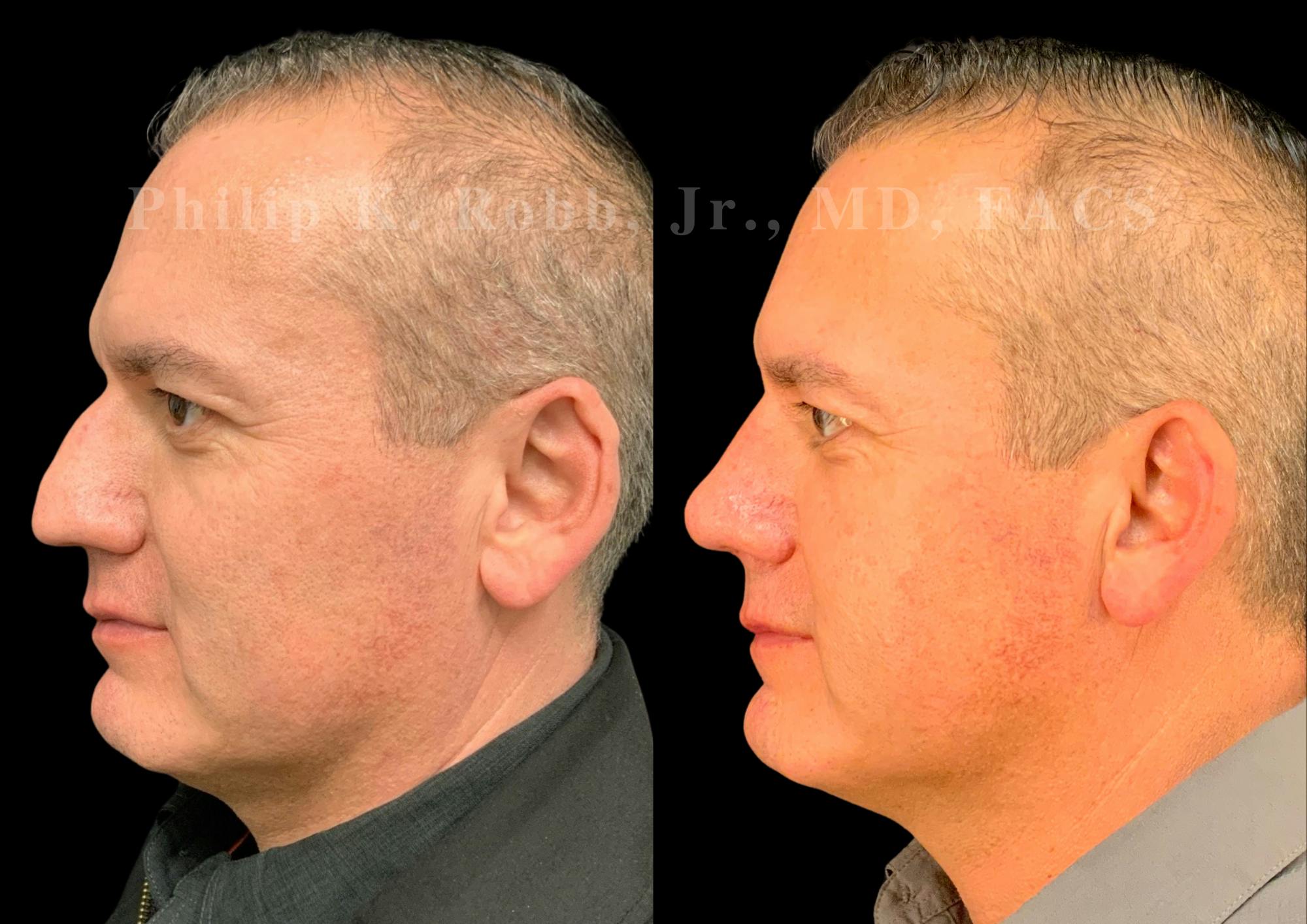 Ultrasonic Rhinoplasty Before & After Gallery - Patient 532770 - Image 5