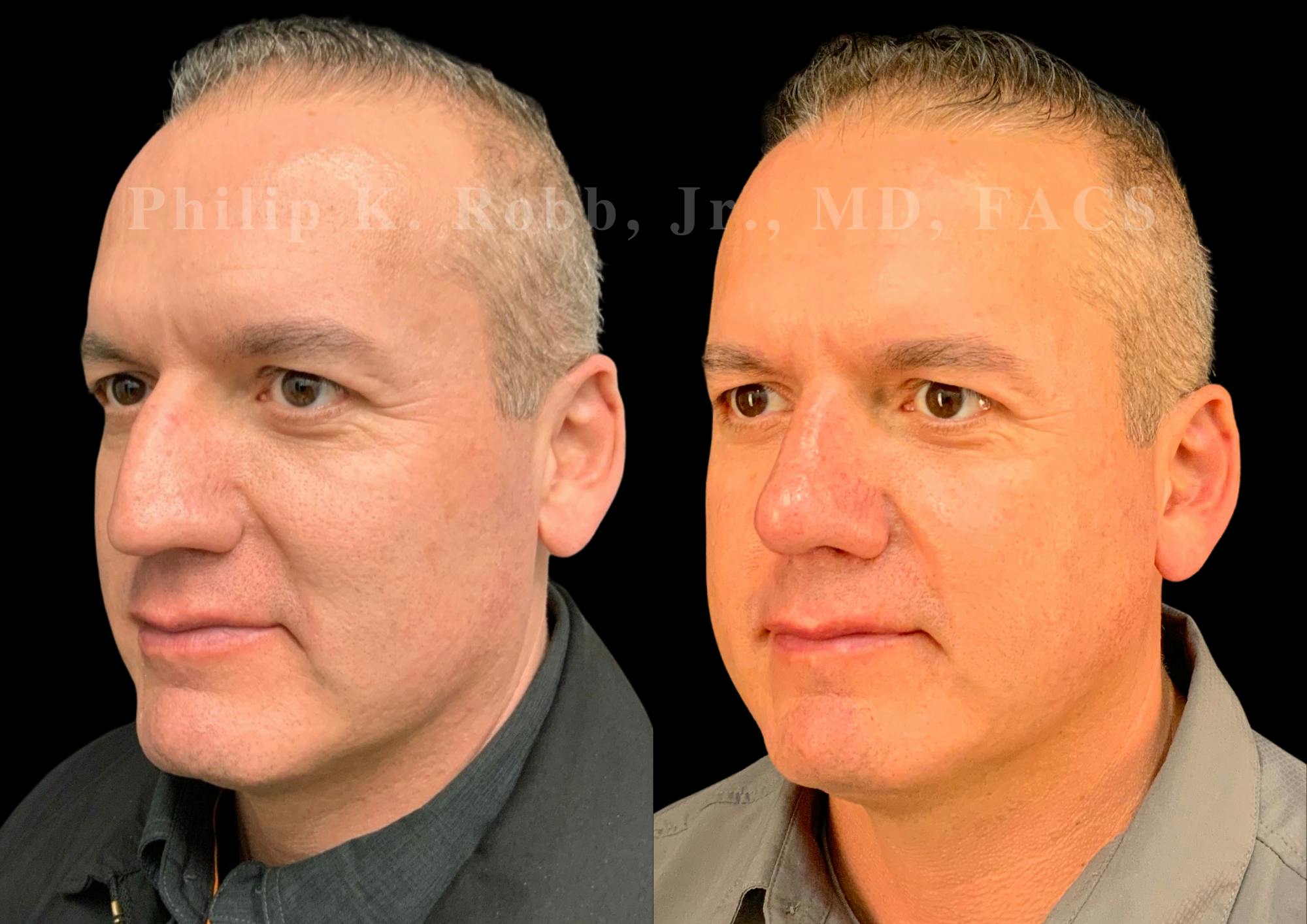 Ultrasonic Rhinoplasty Before & After Gallery - Patient 532770 - Image 4
