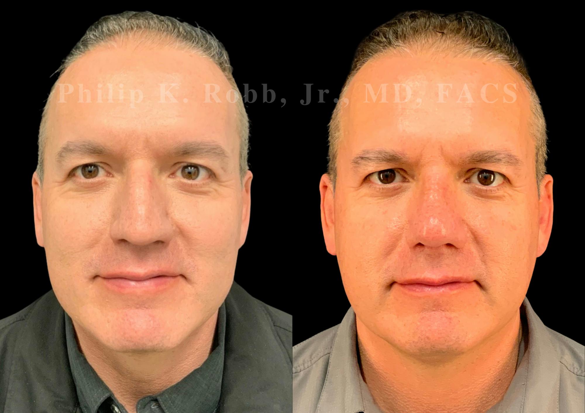 Ultrasonic Rhinoplasty Before & After Gallery - Patient 532770 - Image 3